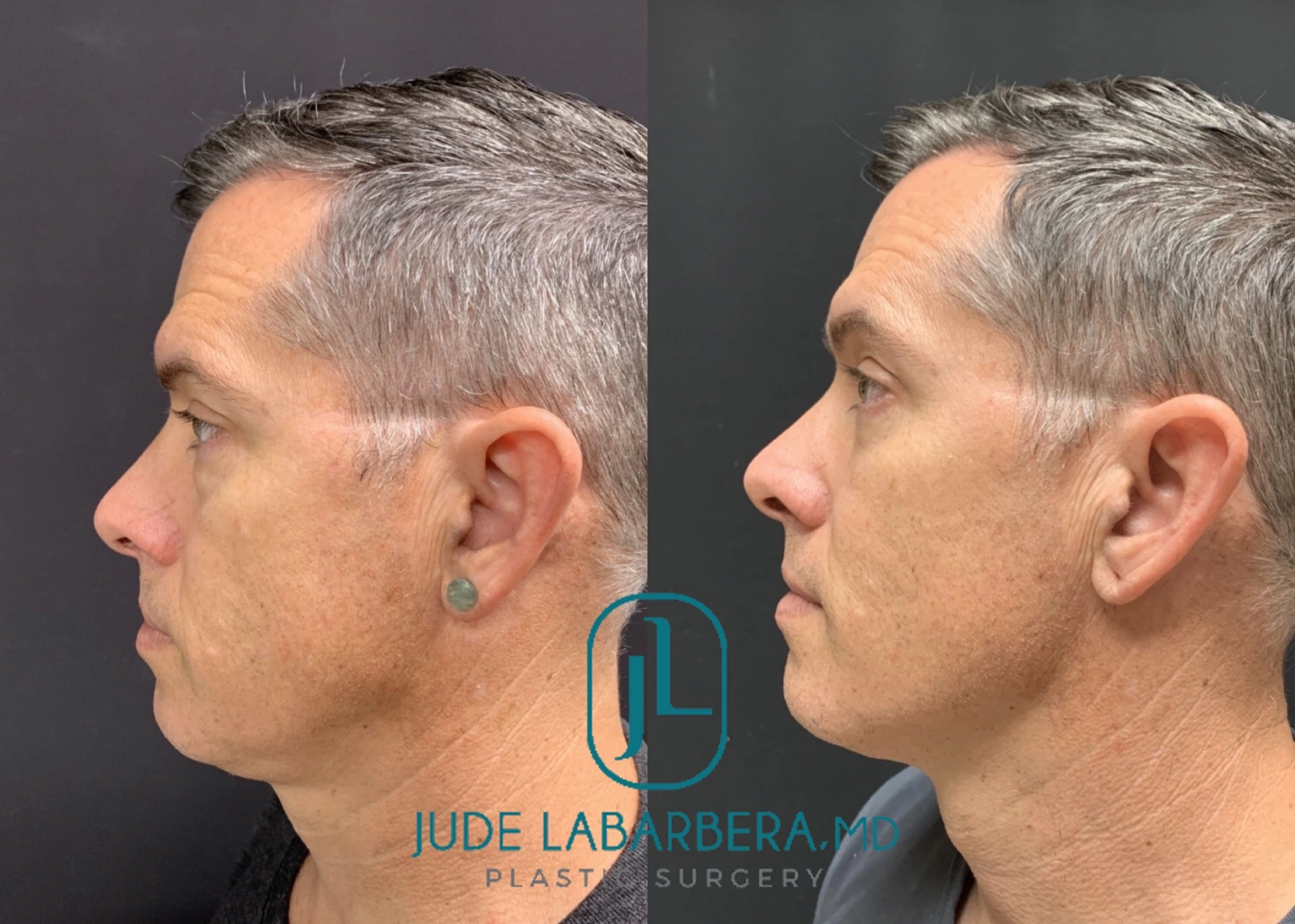 Lower EYELID Lift Before & After Case Number 00016