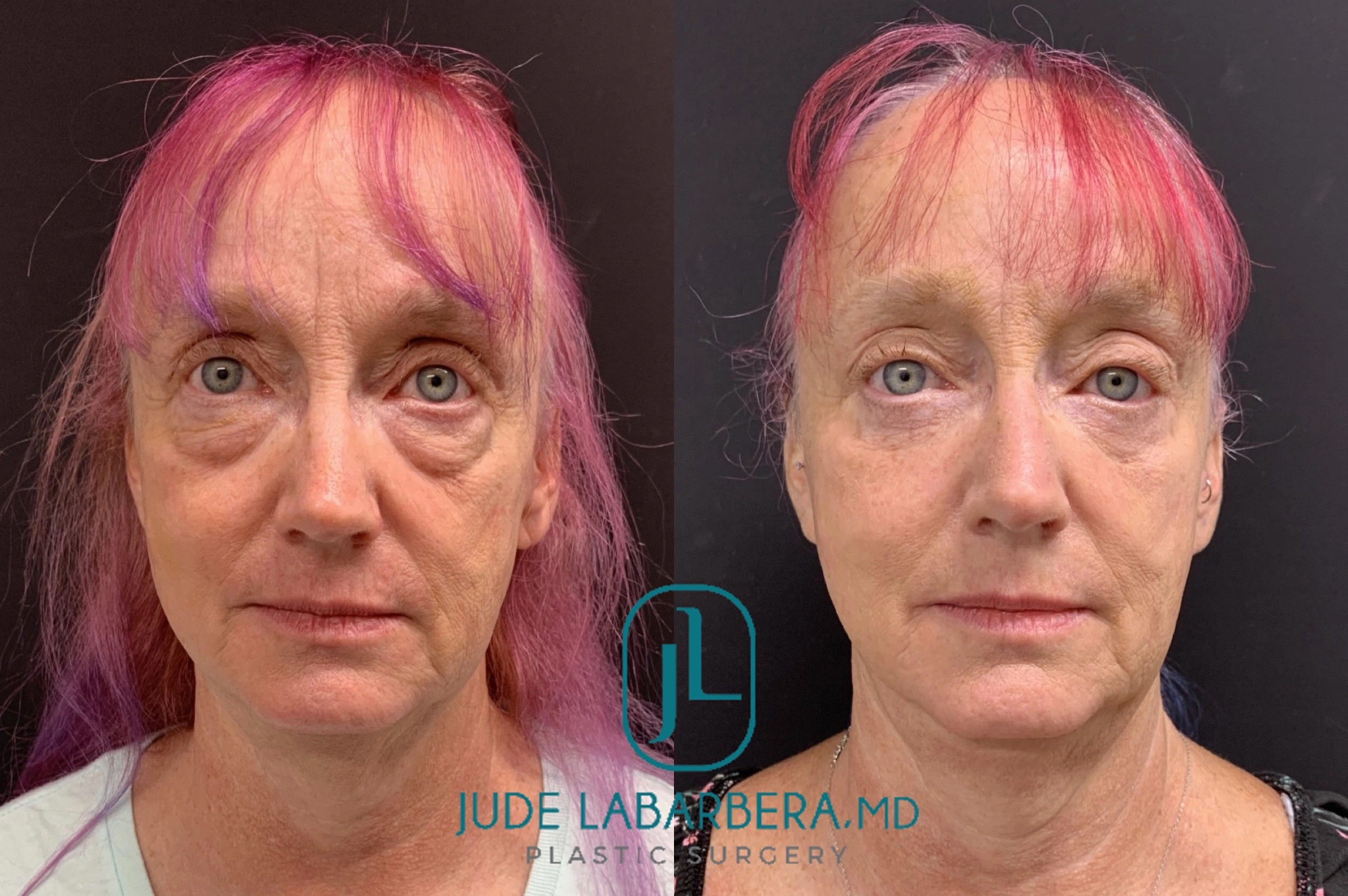 LOWER EYELID SURGERY Before & After Case Number 0009