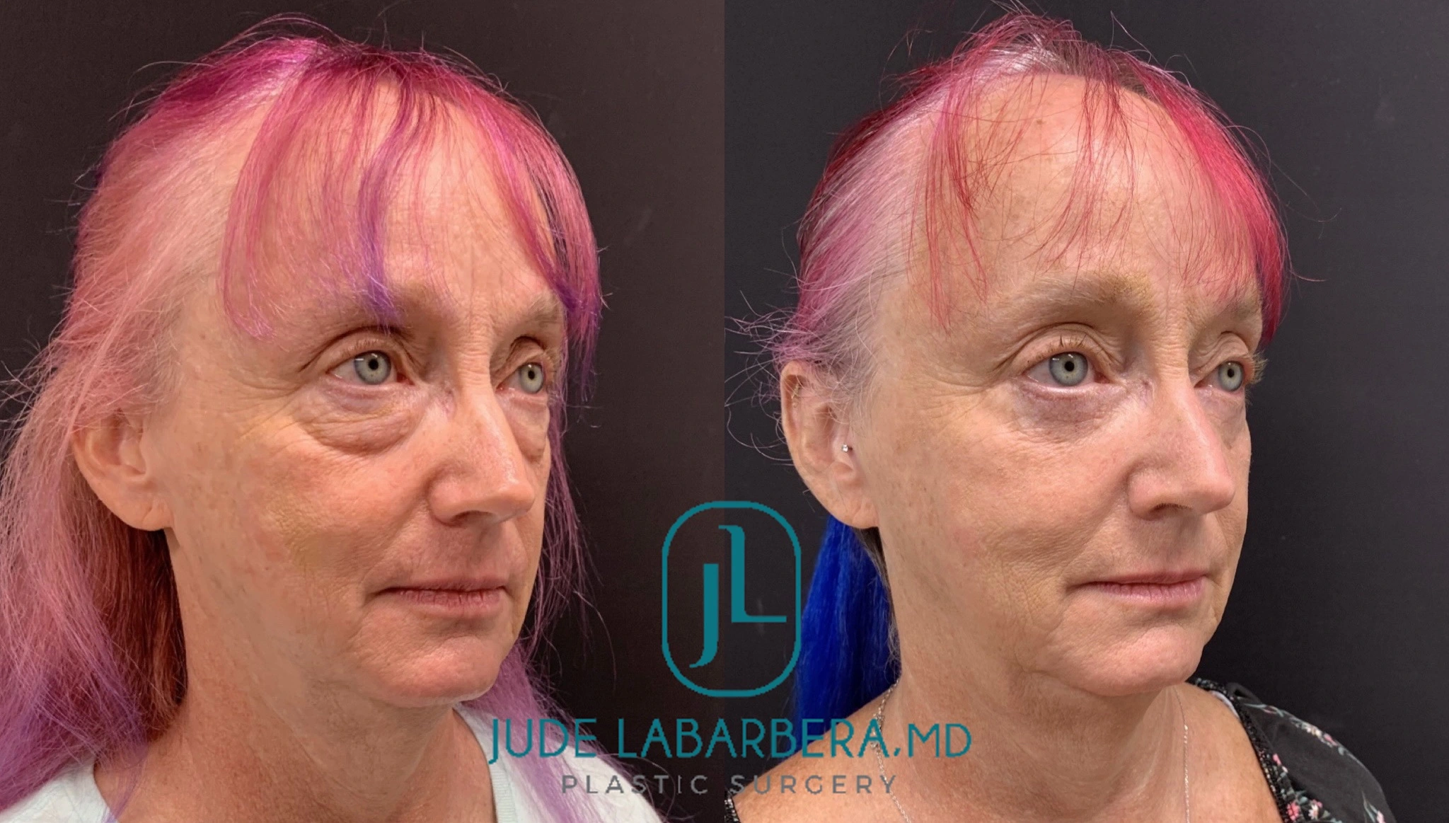 LOWER EYELID SURGERY Before & After Case Number 0009