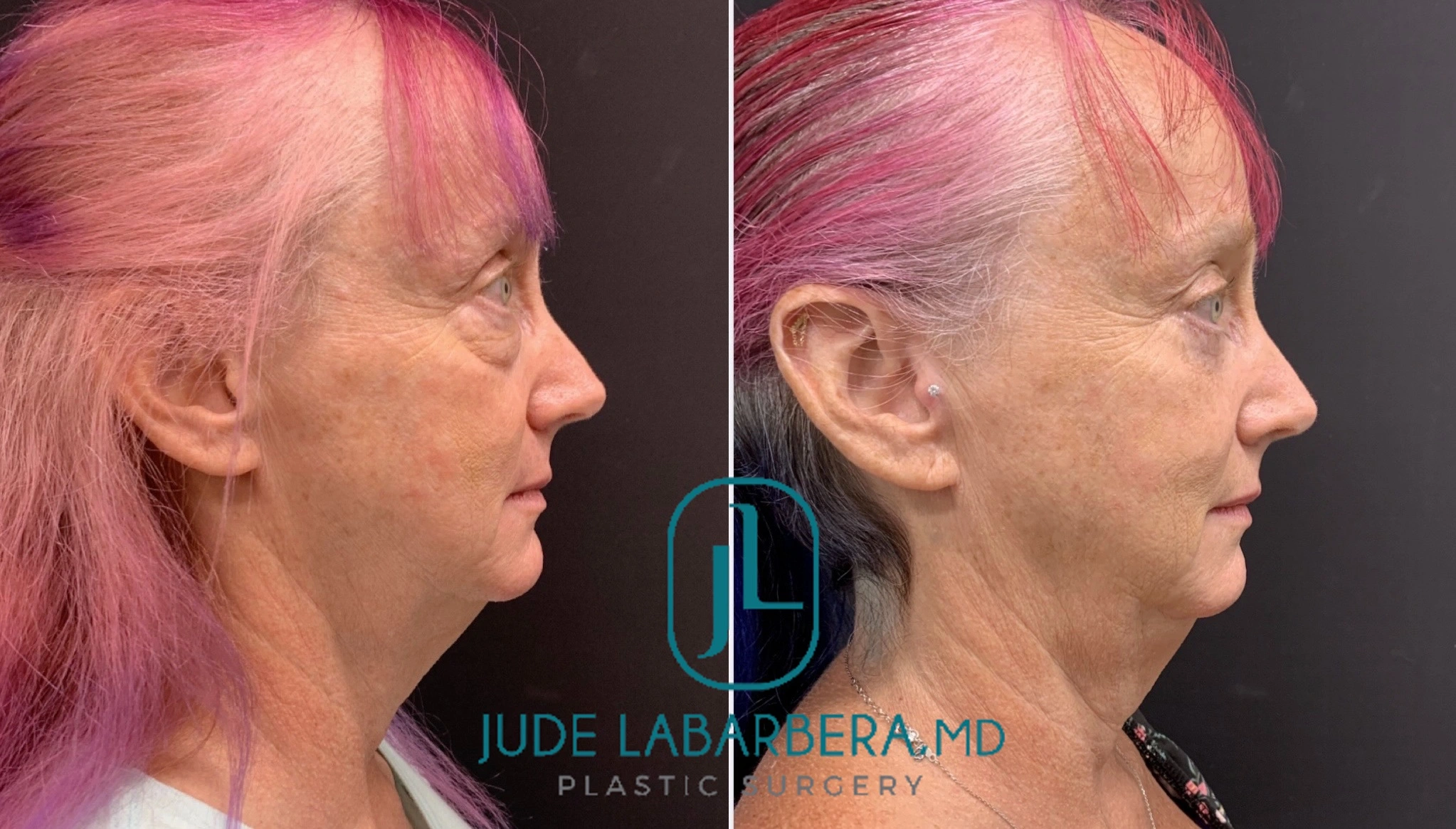 LOWER EYELID SURGERY Before & After Case Number 0009