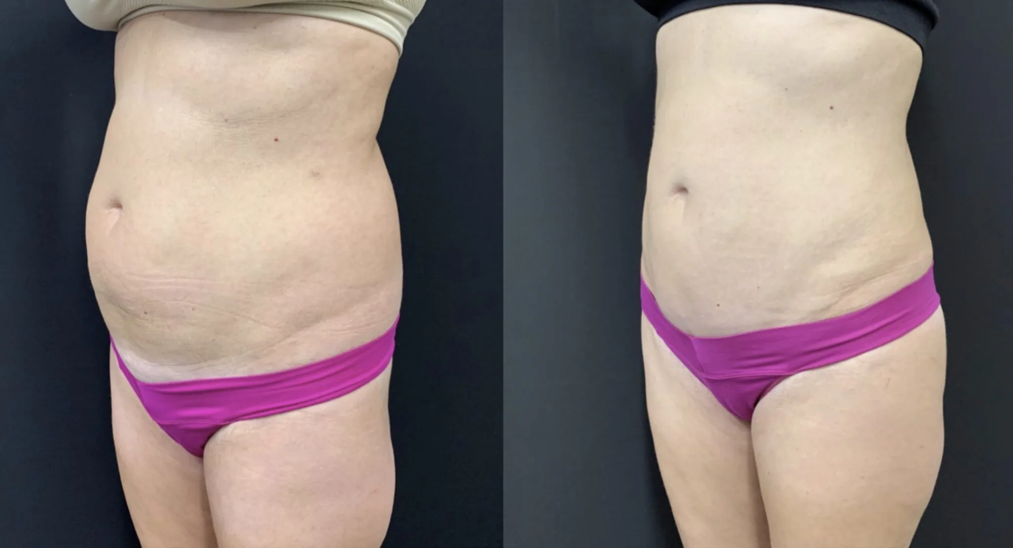 MINI TUMMY TUCK Before & After Case Number 00050