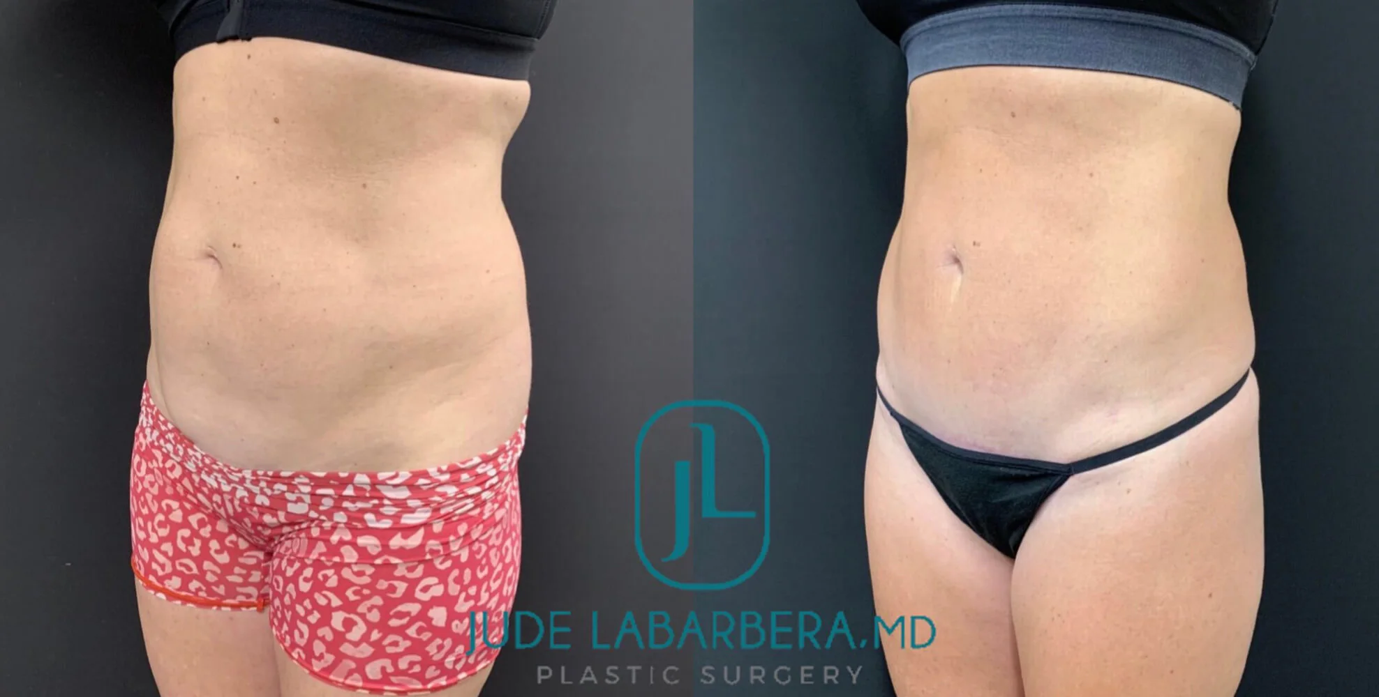 MINI TUMMY TUCK Before & After Case Number 00082