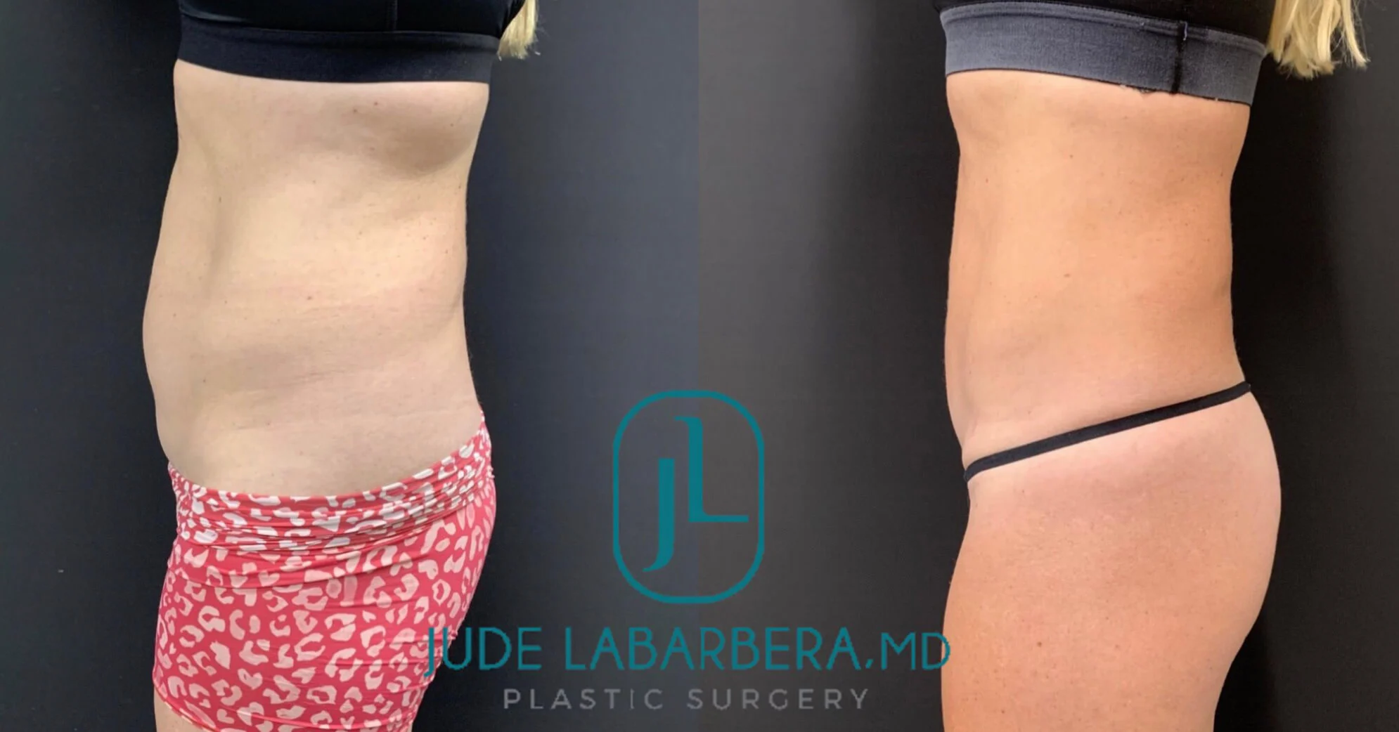 MINI TUMMY TUCK Before & After Case Number 00082