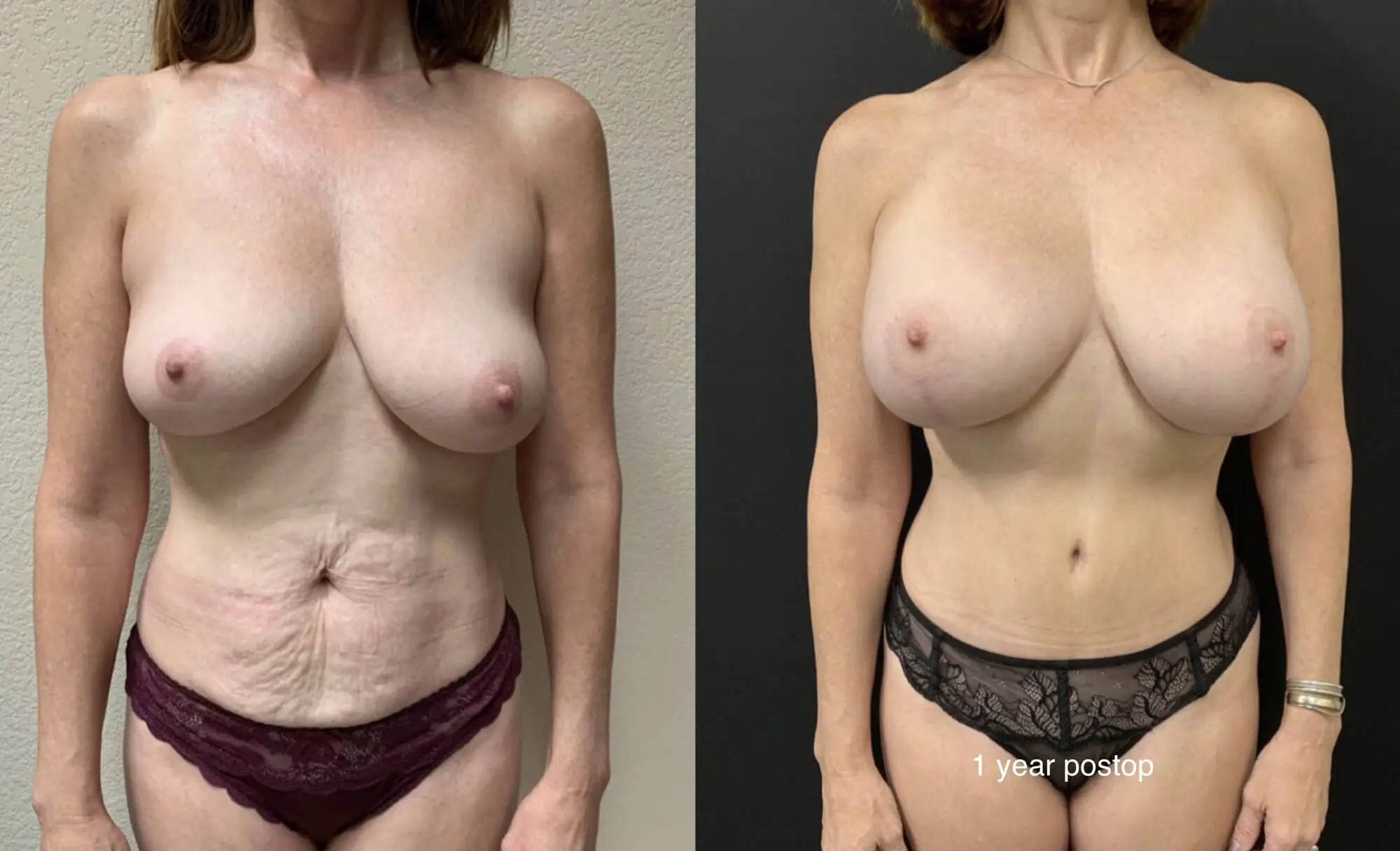 MOMMY MAKEOVER Before & After Case Number 0002