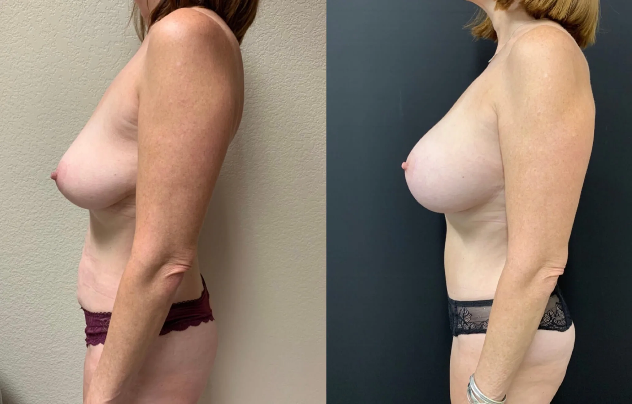 MOMMY MAKEOVER Before & After Case Number 0002
