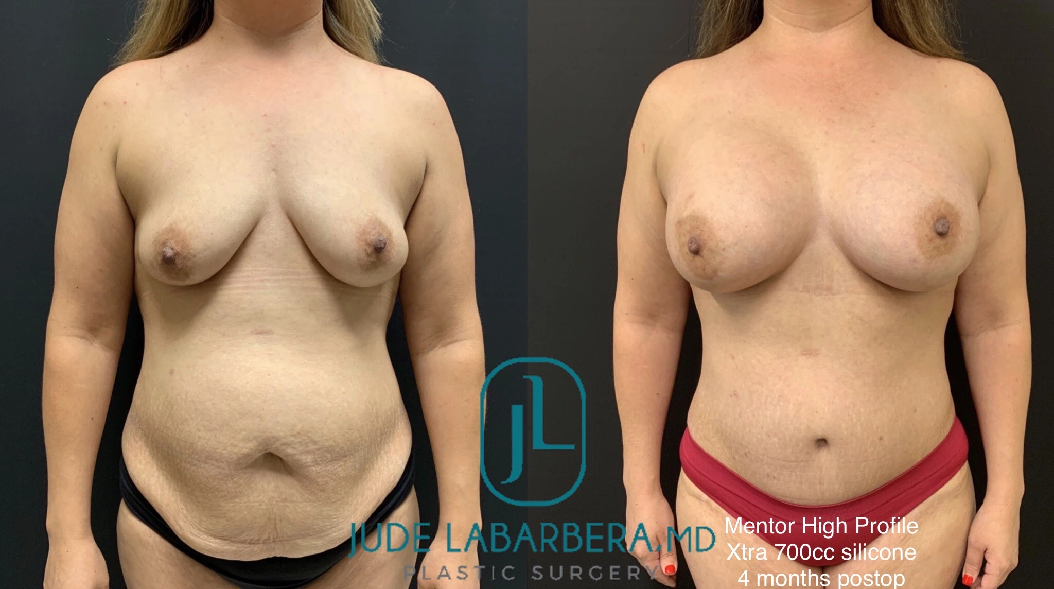 MOMMY MAKEOVER Before & After Case Number 0003
