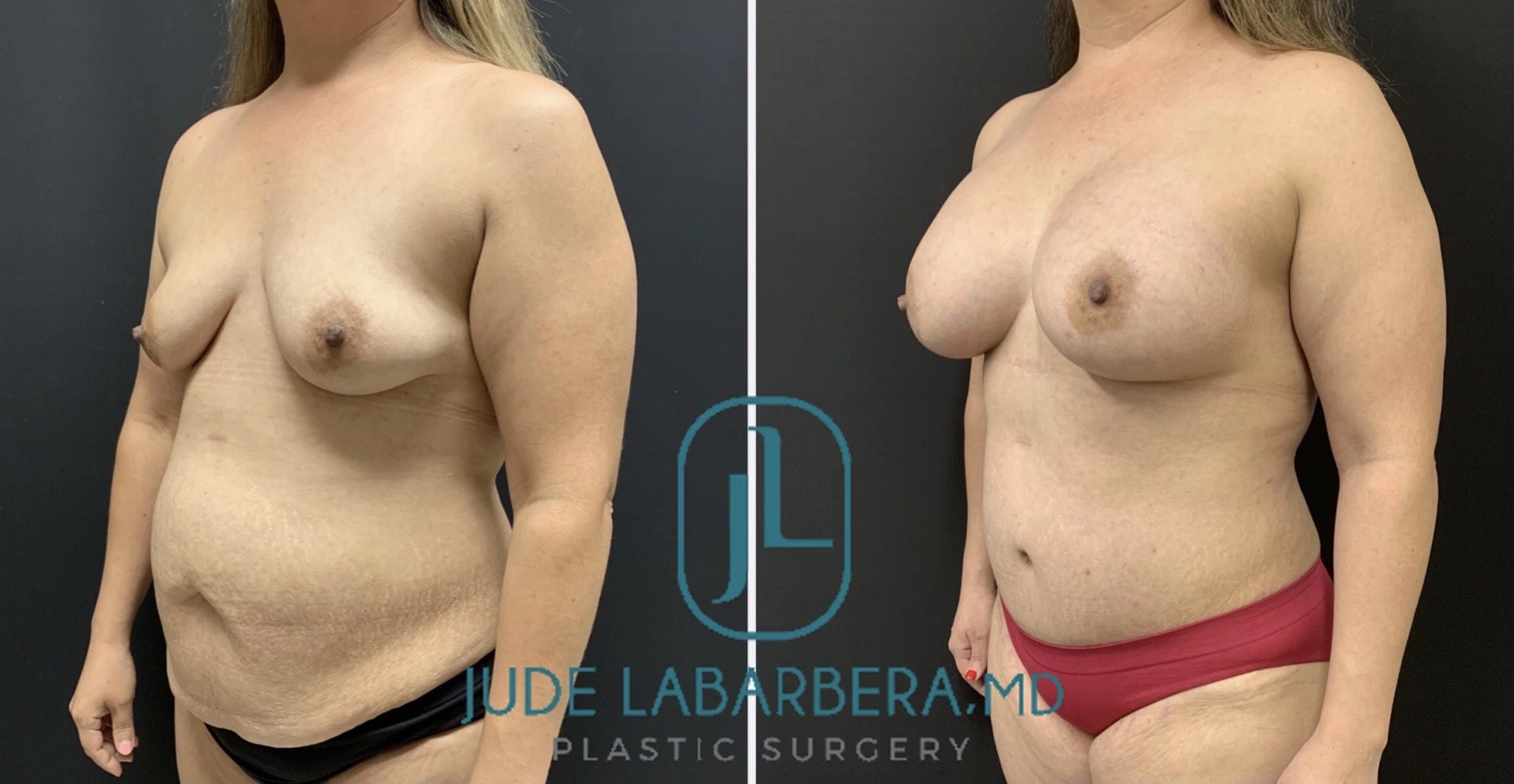 MOMMY MAKEOVER Before & After Case Number 0003