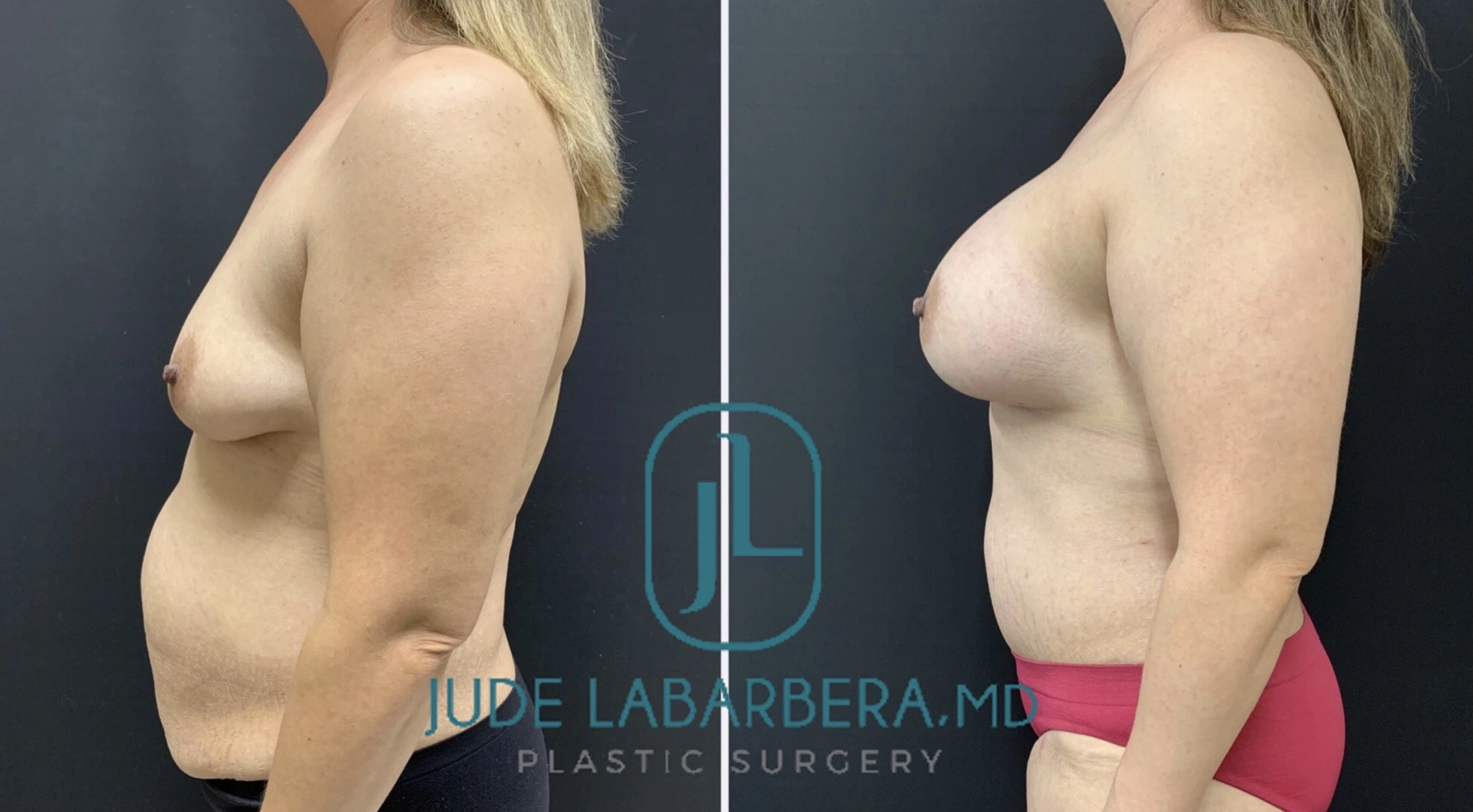 MOMMY MAKEOVER Before & After Case Number 0003