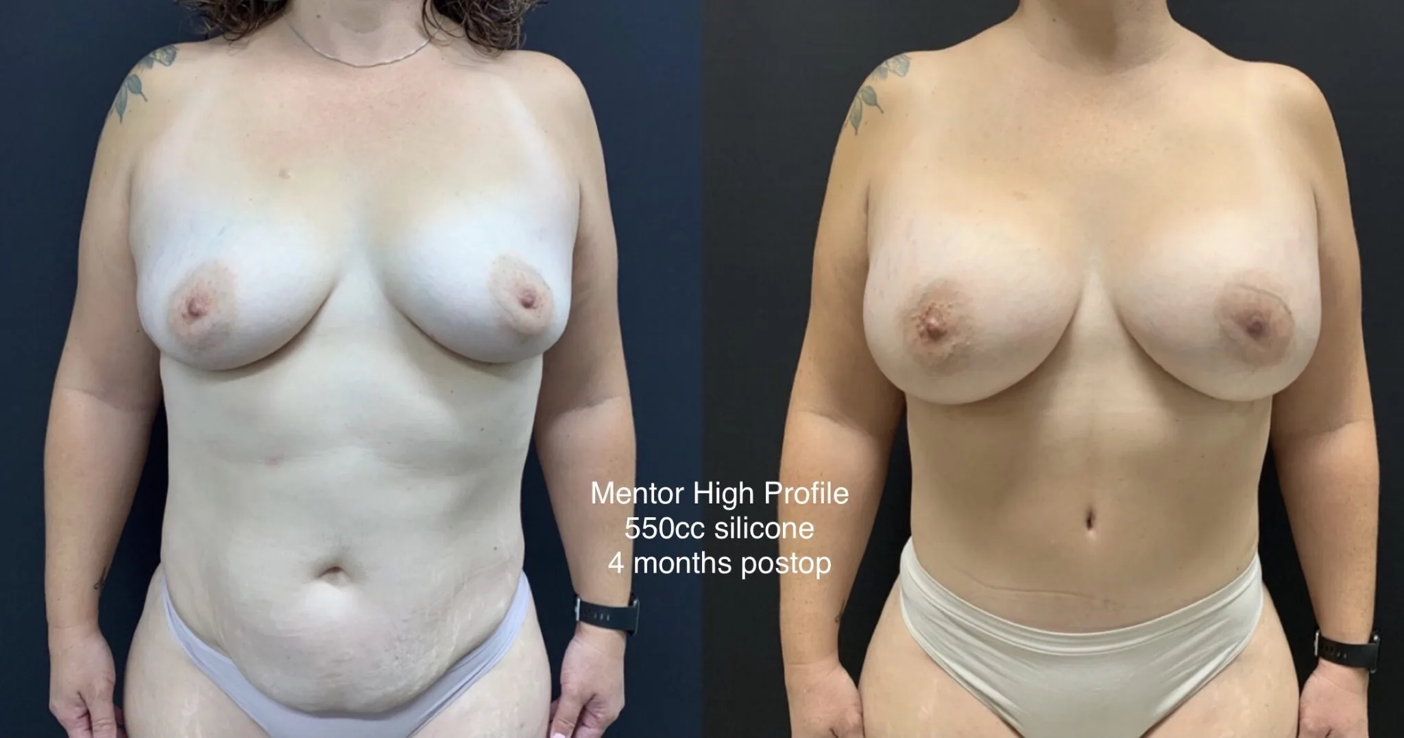 MOMMY MAKEOVER Before & After Case Number 00039