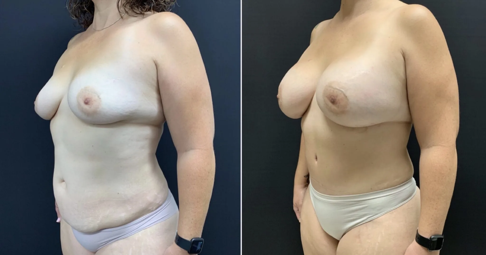 MOMMY MAKEOVER Before & After Case Number 00039
