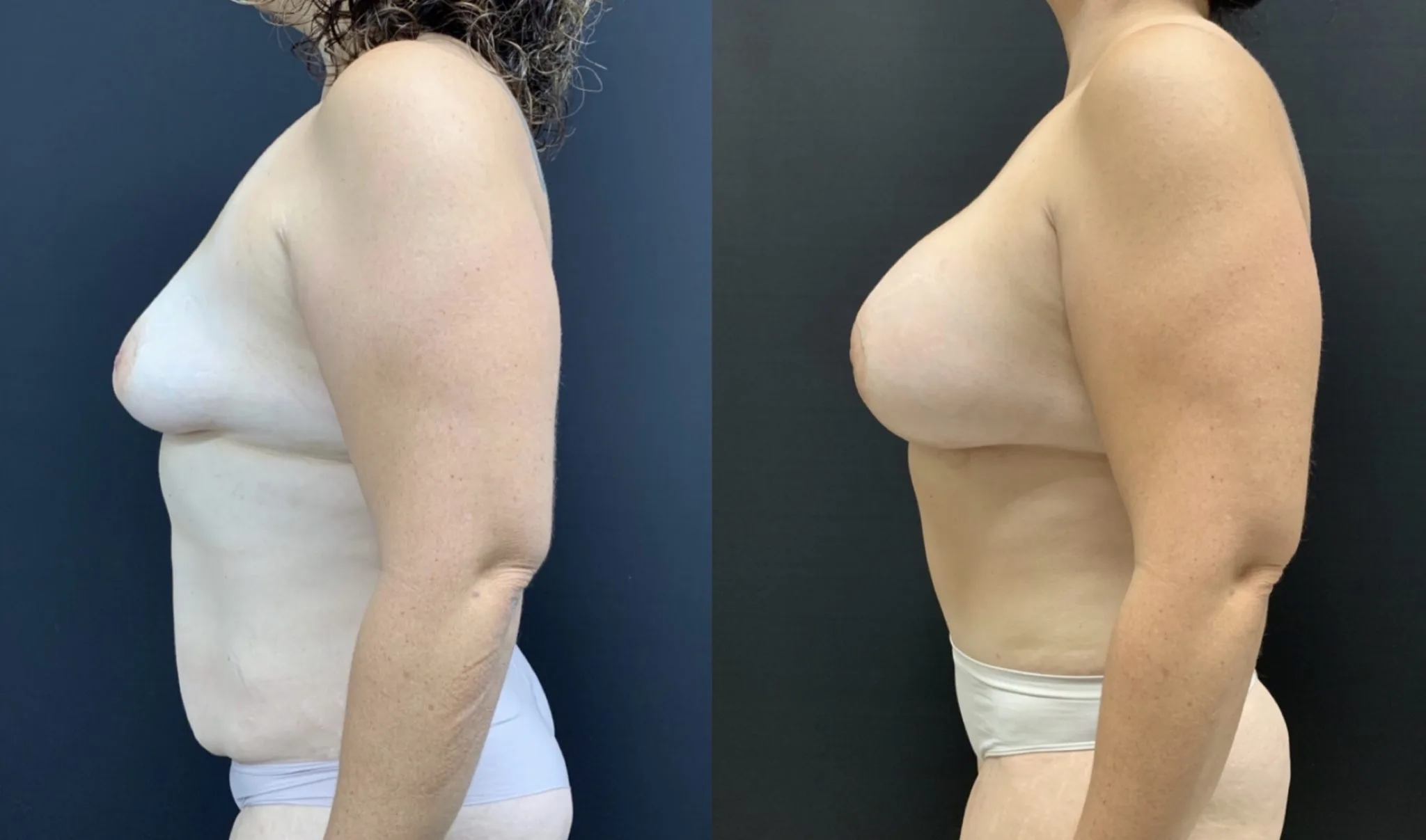 MOMMY MAKEOVER Before & After Case Number 00039