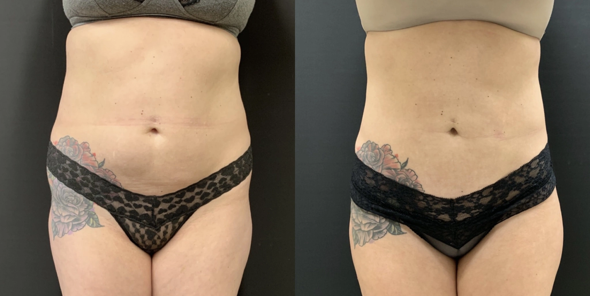 NATURAL BRAZILIAN BUTT LIFT Before & After case 5
