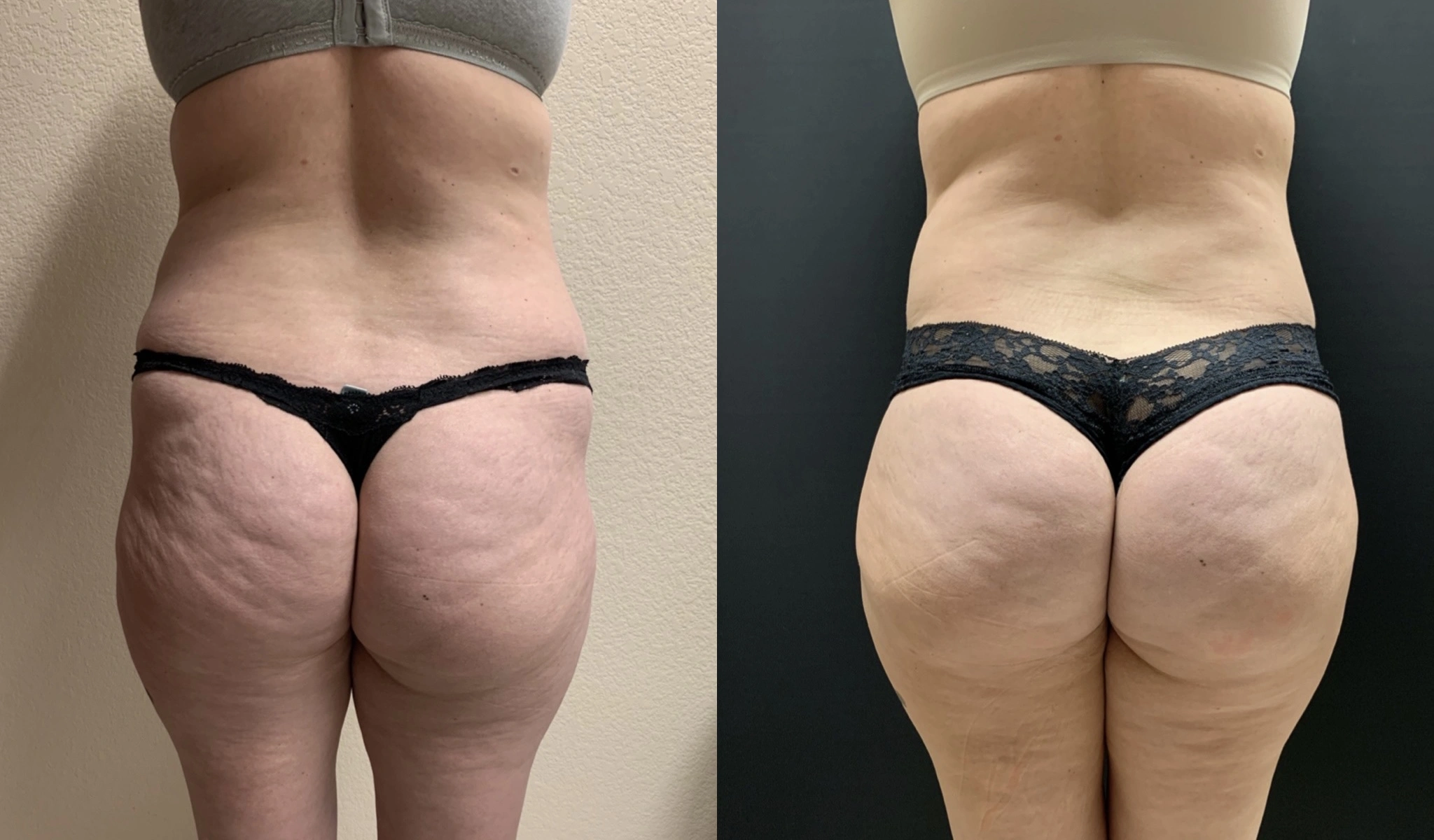 NATURAL BRAZILIAN BUTT LIFT Before & After case 5