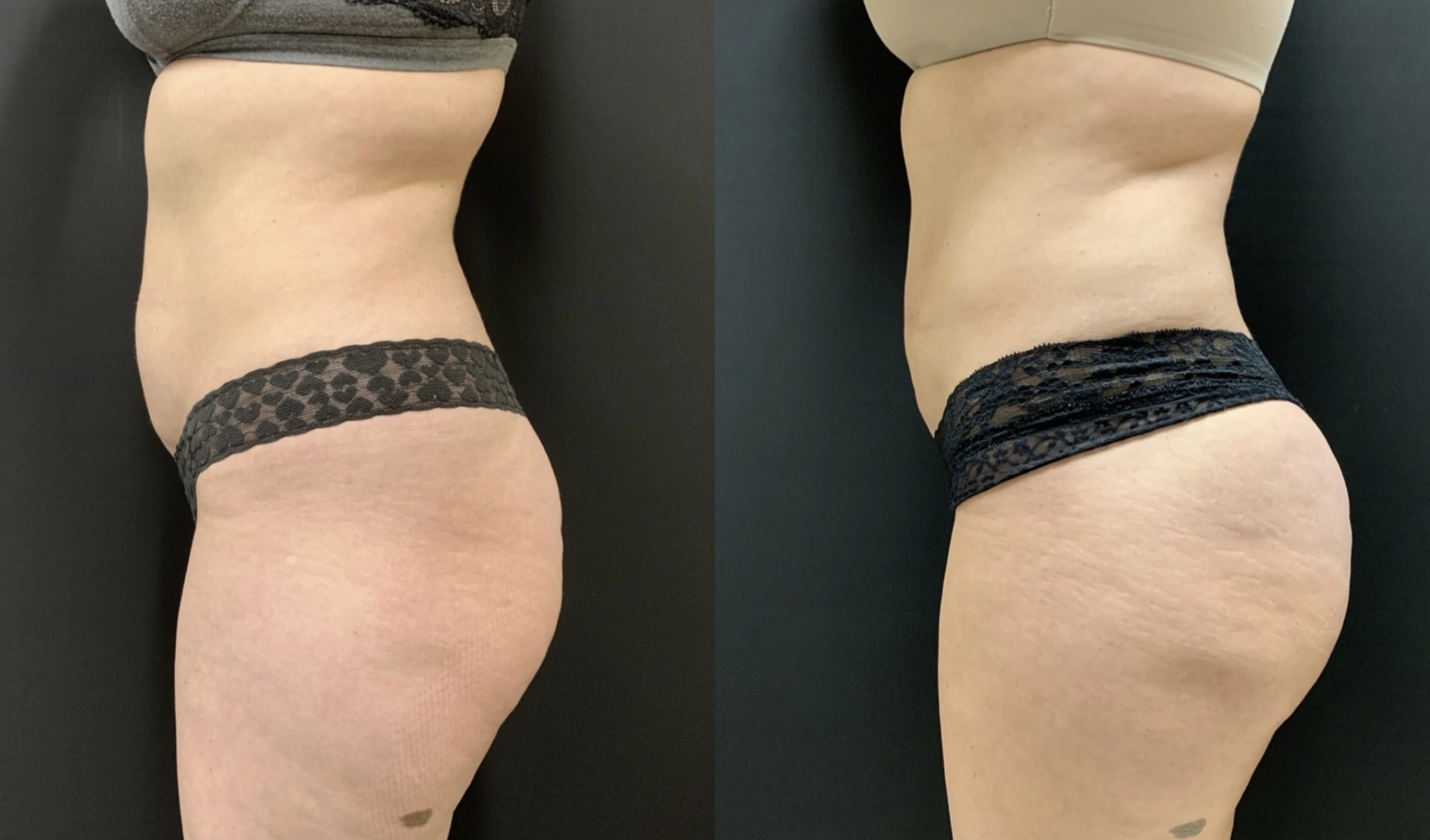 NATURAL BRAZILIAN BUTT LIFT Before & After case 5