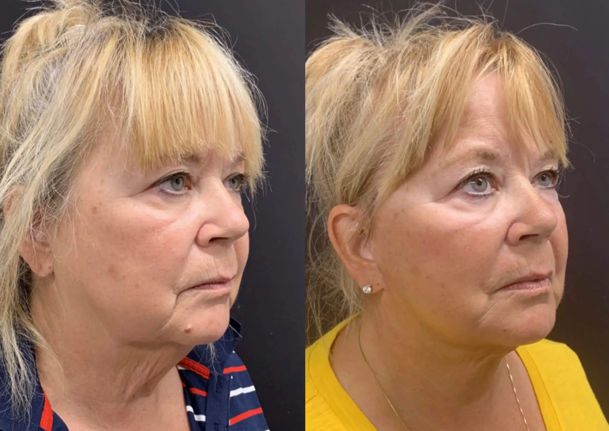 NATURAL FACE AND NECK LIFT Before & After case 3