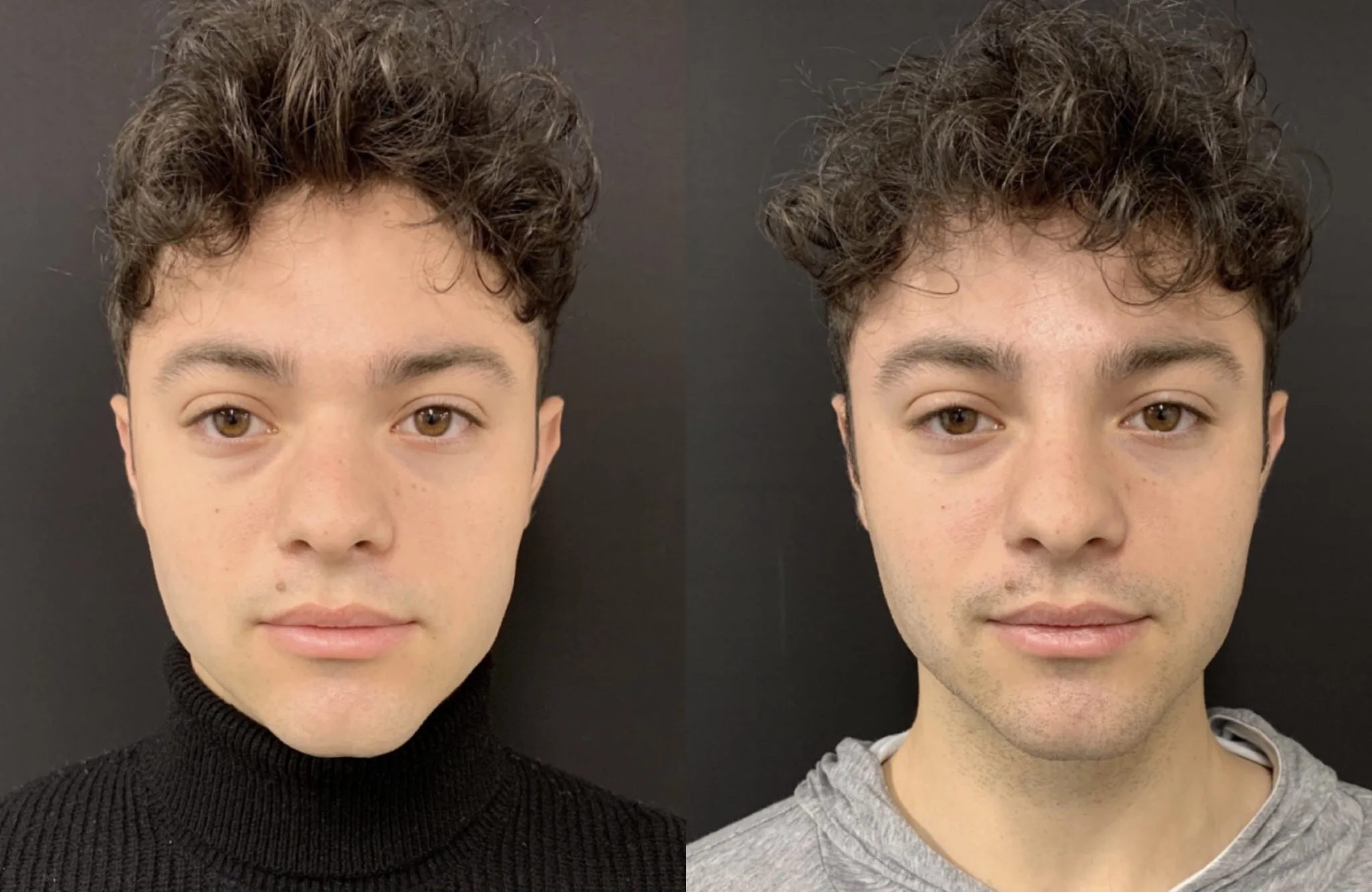NATURAL NON-SURGICAL RHINOPLASTY Before & After Case Number 0007