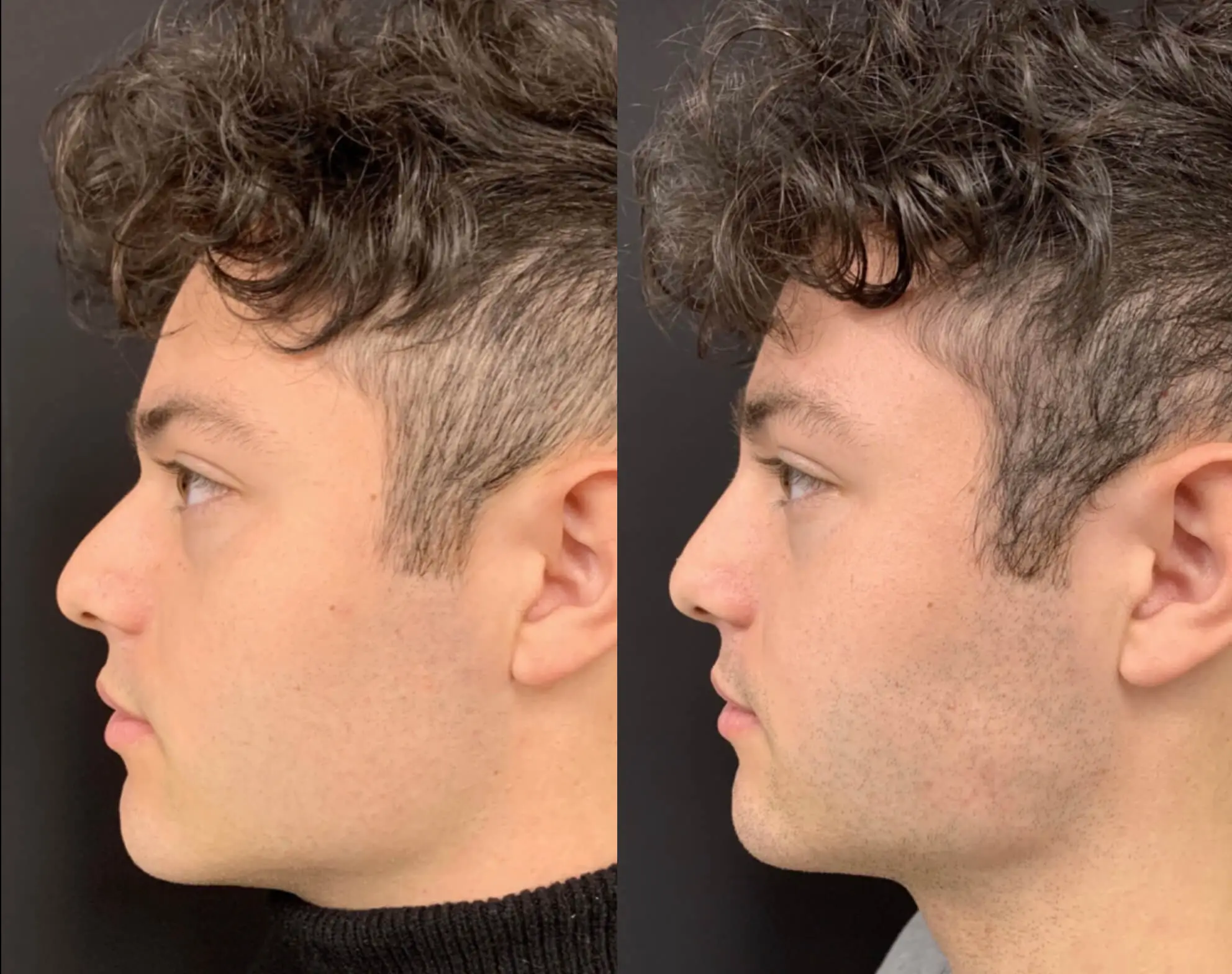 NATURAL NON-SURGICAL RHINOPLASTY Before & After Case Number 0007