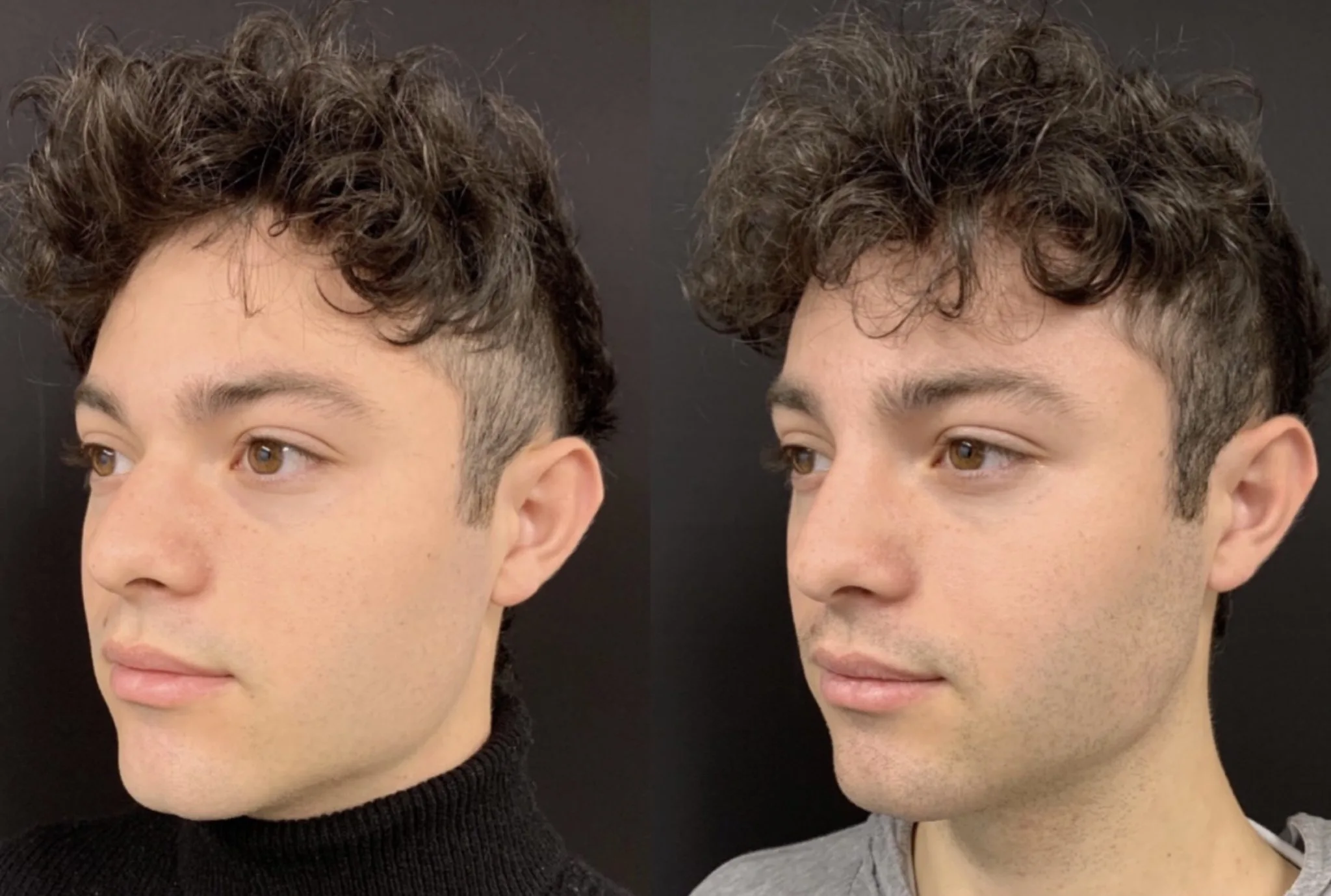 NATURAL NON-SURGICAL RHINOPLASTY Before & After Case Number 0007