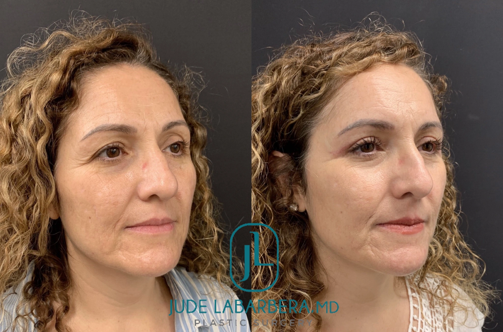 NATURAL RESULT AFTER UPPER EYELID LIFT – UPPER BLEPHAROPLASTY Before & After Case Number 00017
