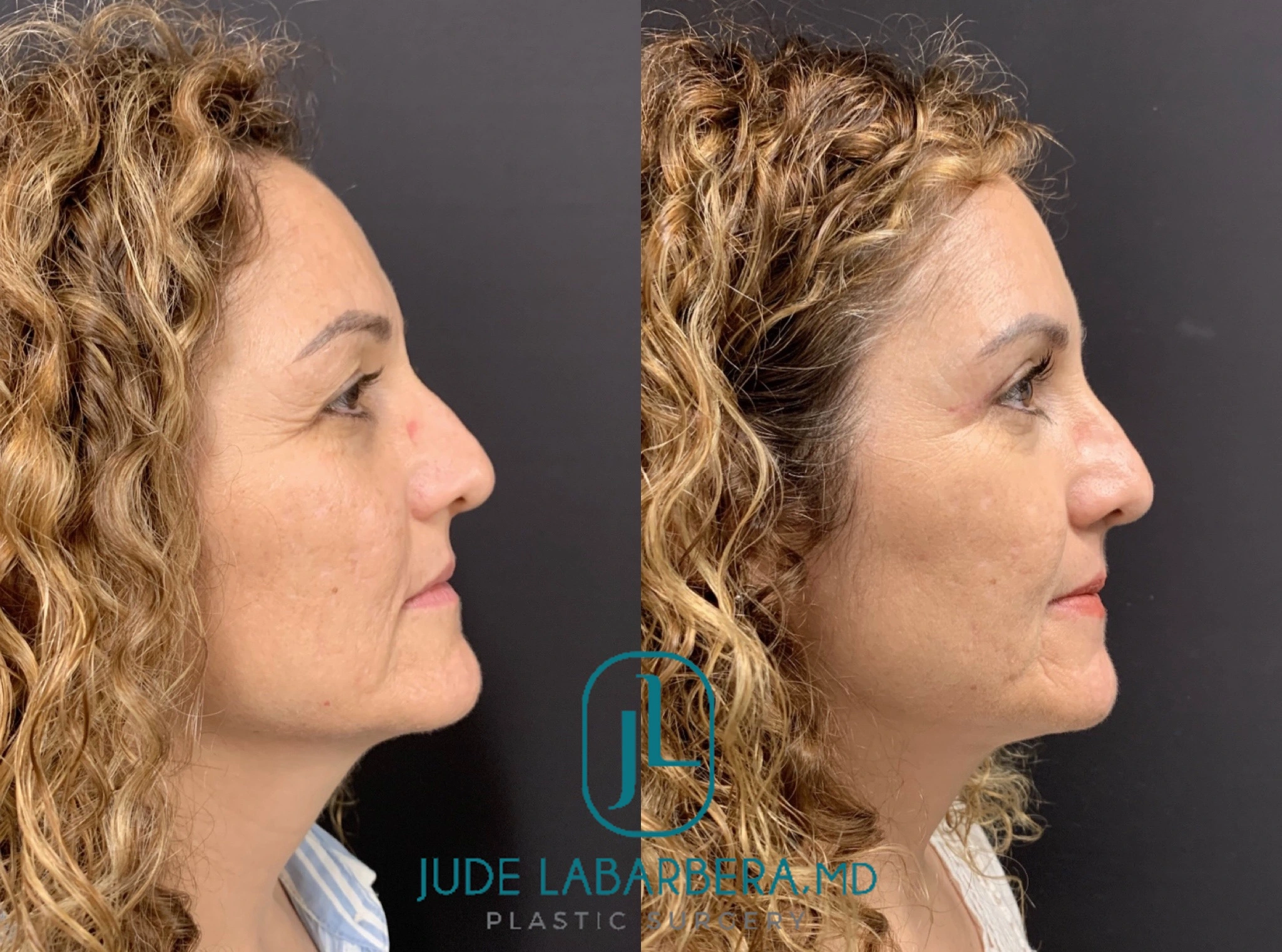 NATURAL RESULT AFTER UPPER EYELID LIFT – UPPER BLEPHAROPLASTY Before & After Case Number 00017