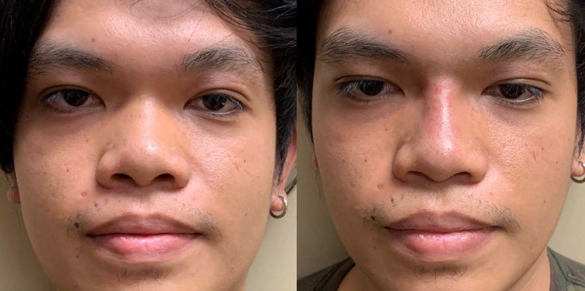 NATURAL RESULT NON-SURGICAL RHINOPLASTY Before & After Case Number 0002