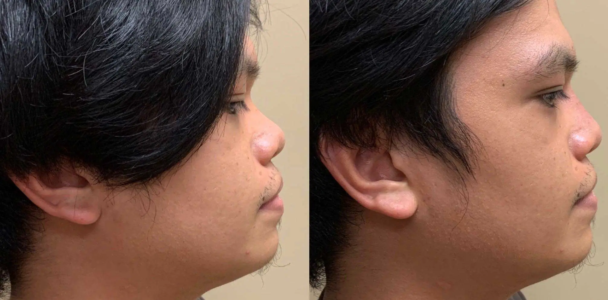 NATURAL RESULT NON-SURGICAL RHINOPLASTY Before & After Case Number 0002
