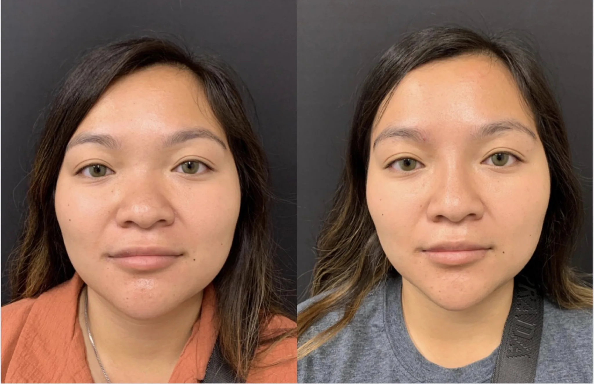 NATURAL RESULT NON-SURGICAL RHINOPLASTY Before & After Case Number 0003