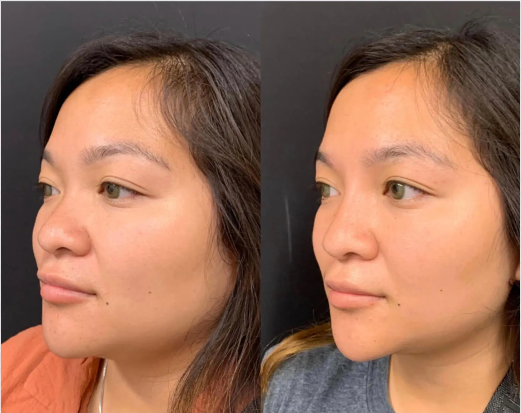 NATURAL RESULT NON-SURGICAL RHINOPLASTY Before & After Case Number 0003