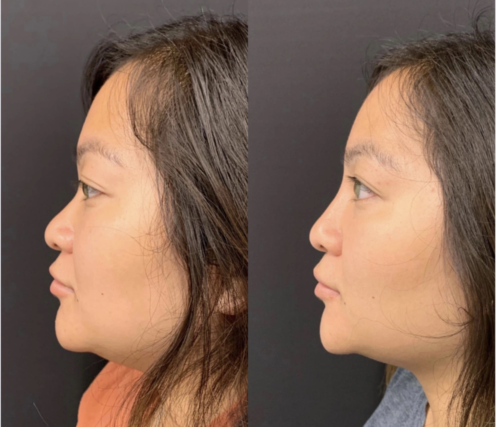 NATURAL RESULT NON-SURGICAL RHINOPLASTY Before & After Case Number 0003