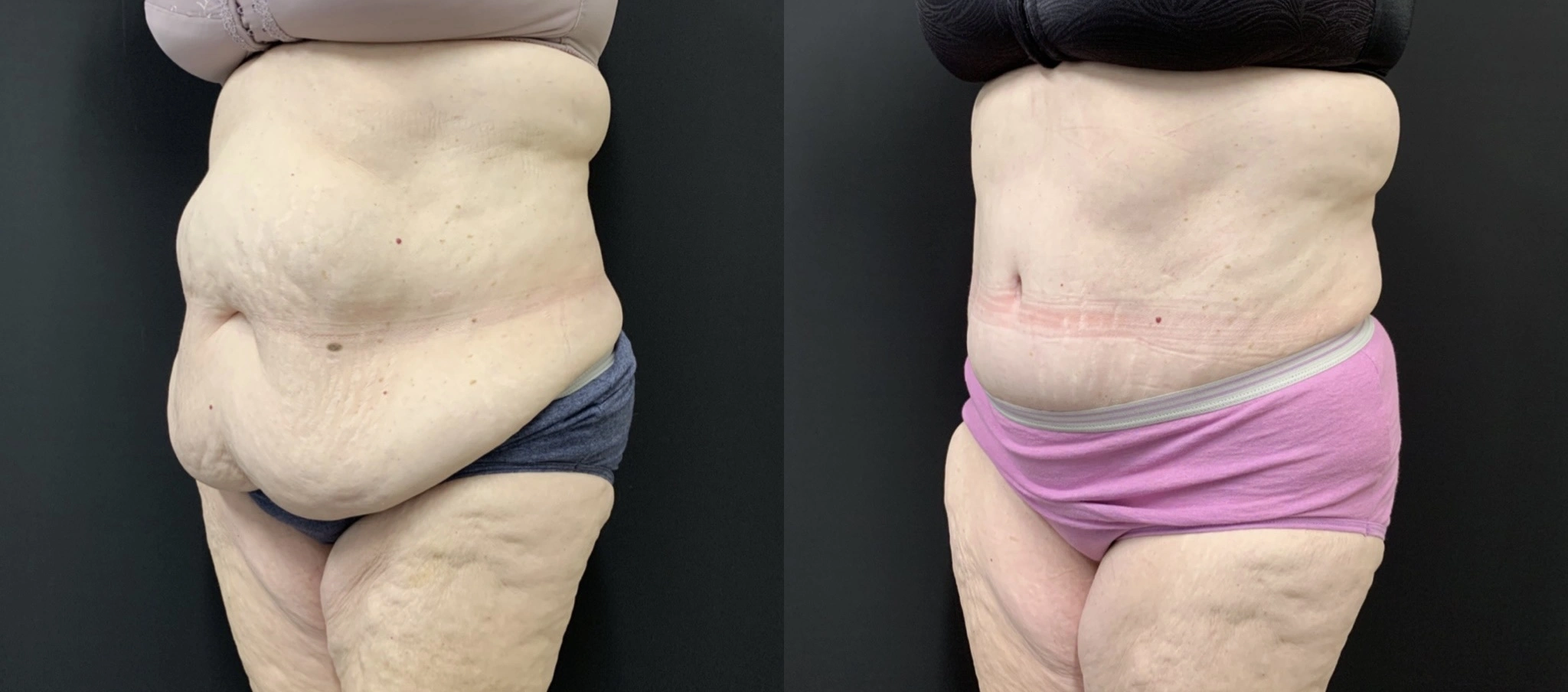 NATURAL Tummy Tuck Before & After Case Number 0005