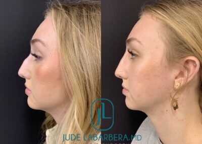 NON-SURGICAL NOSE JOB Before & After