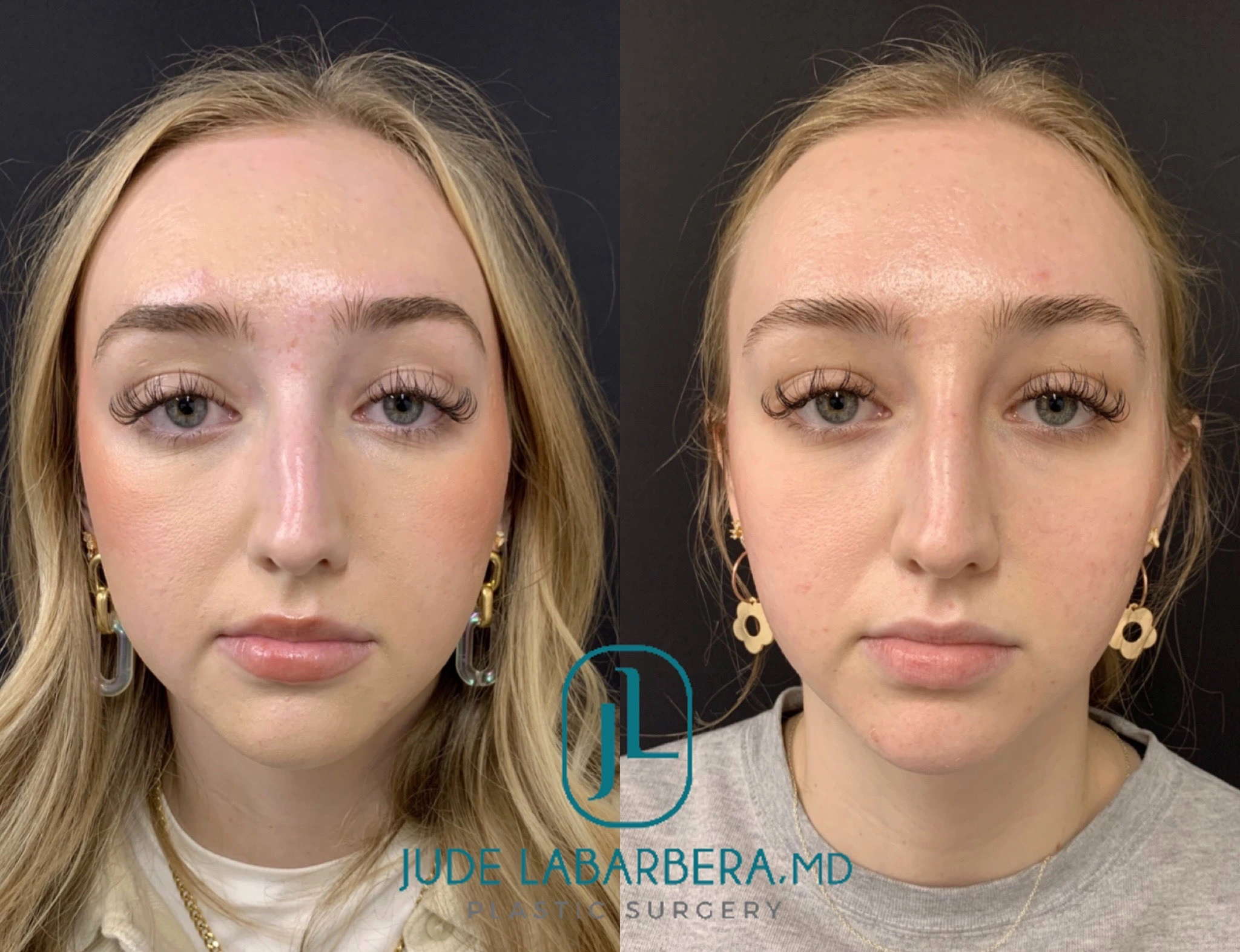 NON-SURGICAL RHINOPLASTY Before & After Case Number 00011