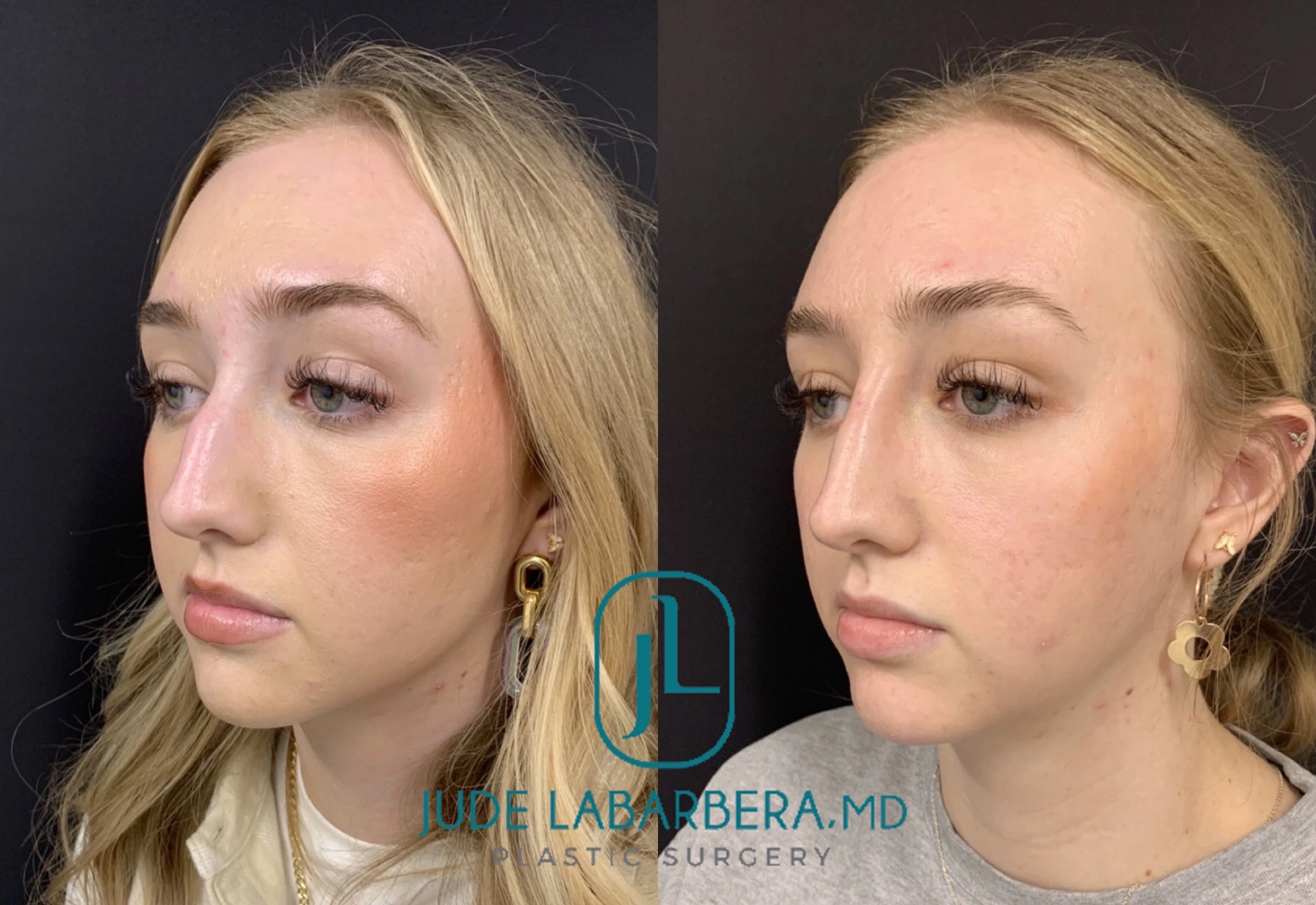 NON-SURGICAL RHINOPLASTY Before & After Case Number 00011