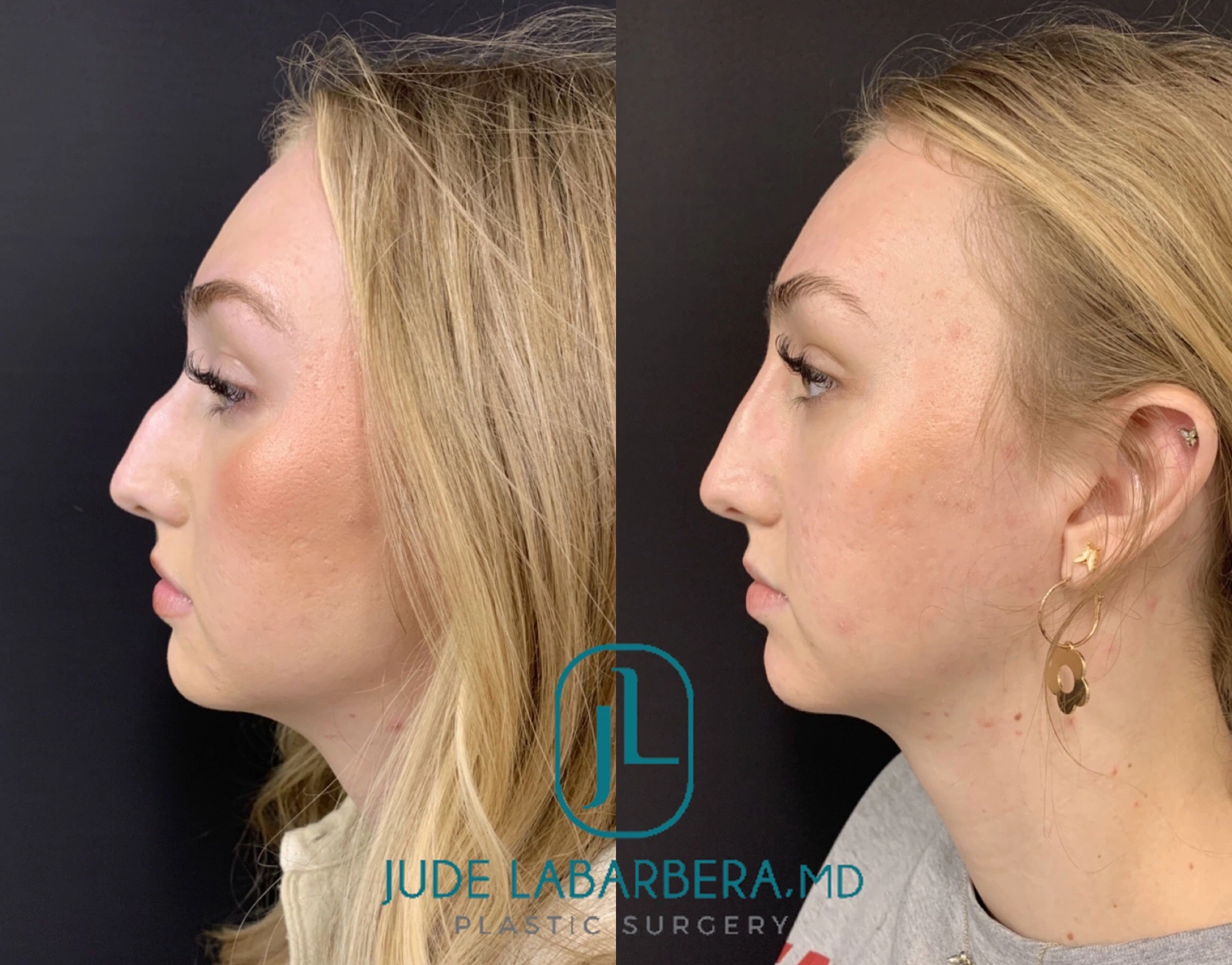 NON-SURGICAL RHINOPLASTY Before & After Case Number 00011
