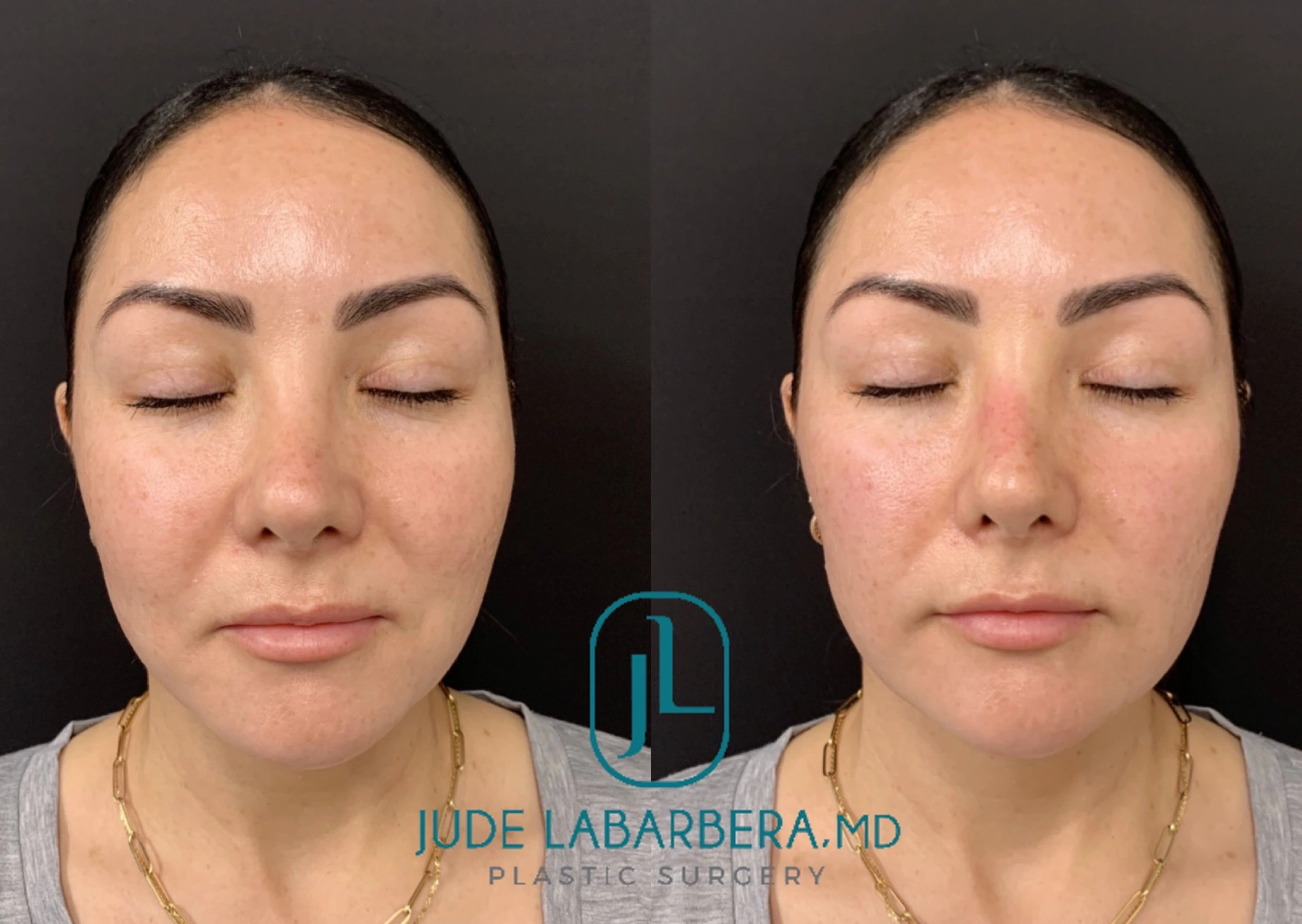 NON-SURGICAL RHINOPLASTY Before & After Case Number 0008