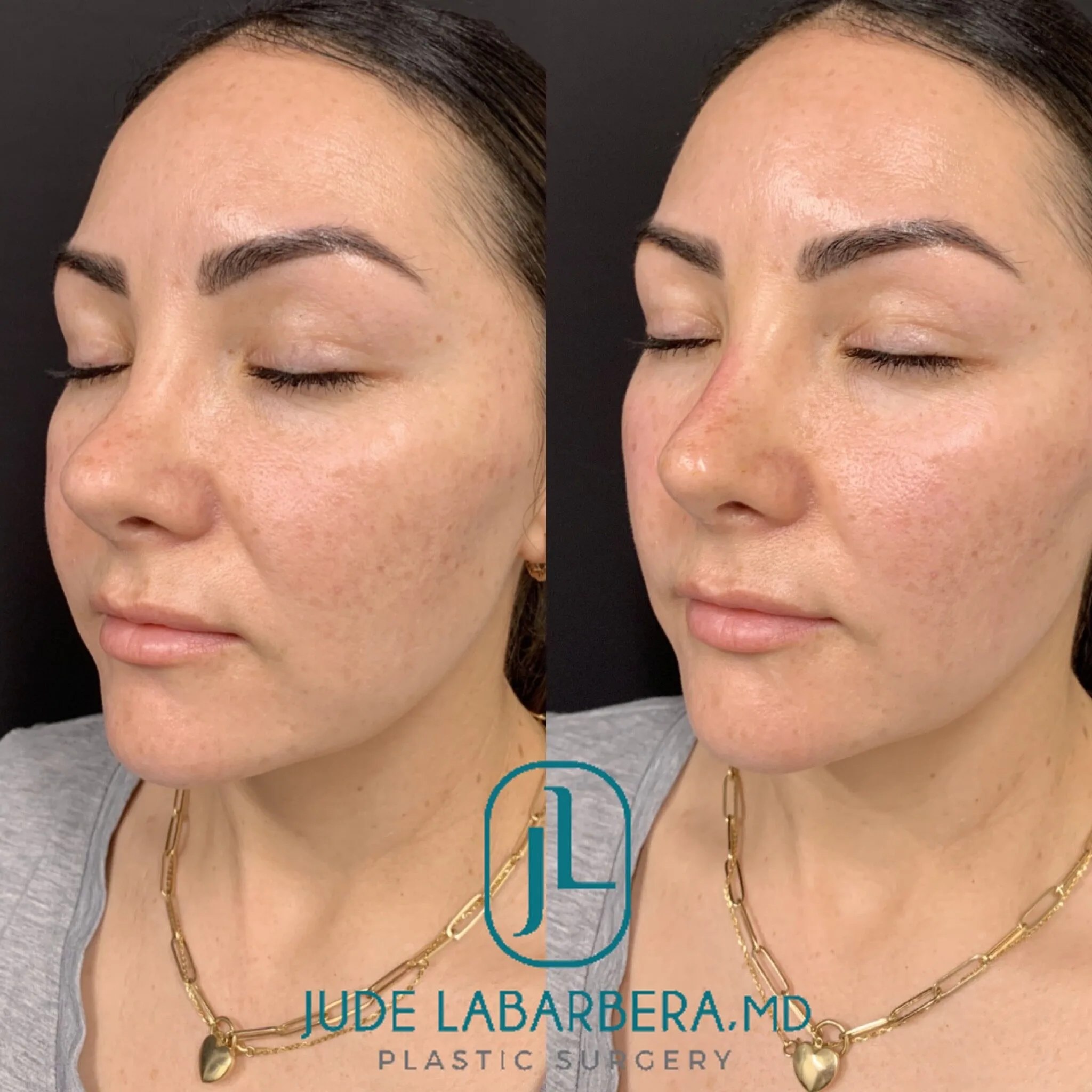 NON-SURGICAL RHINOPLASTY Before & After Case Number 0008