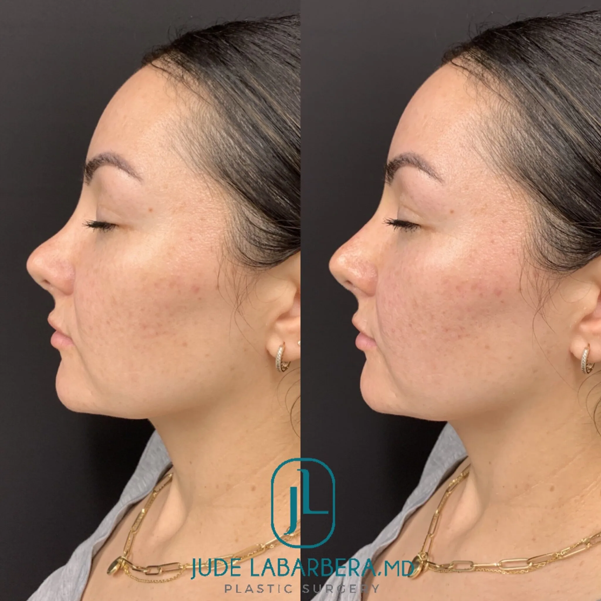 NON-SURGICAL RHINOPLASTY Before & After Case Number 0008