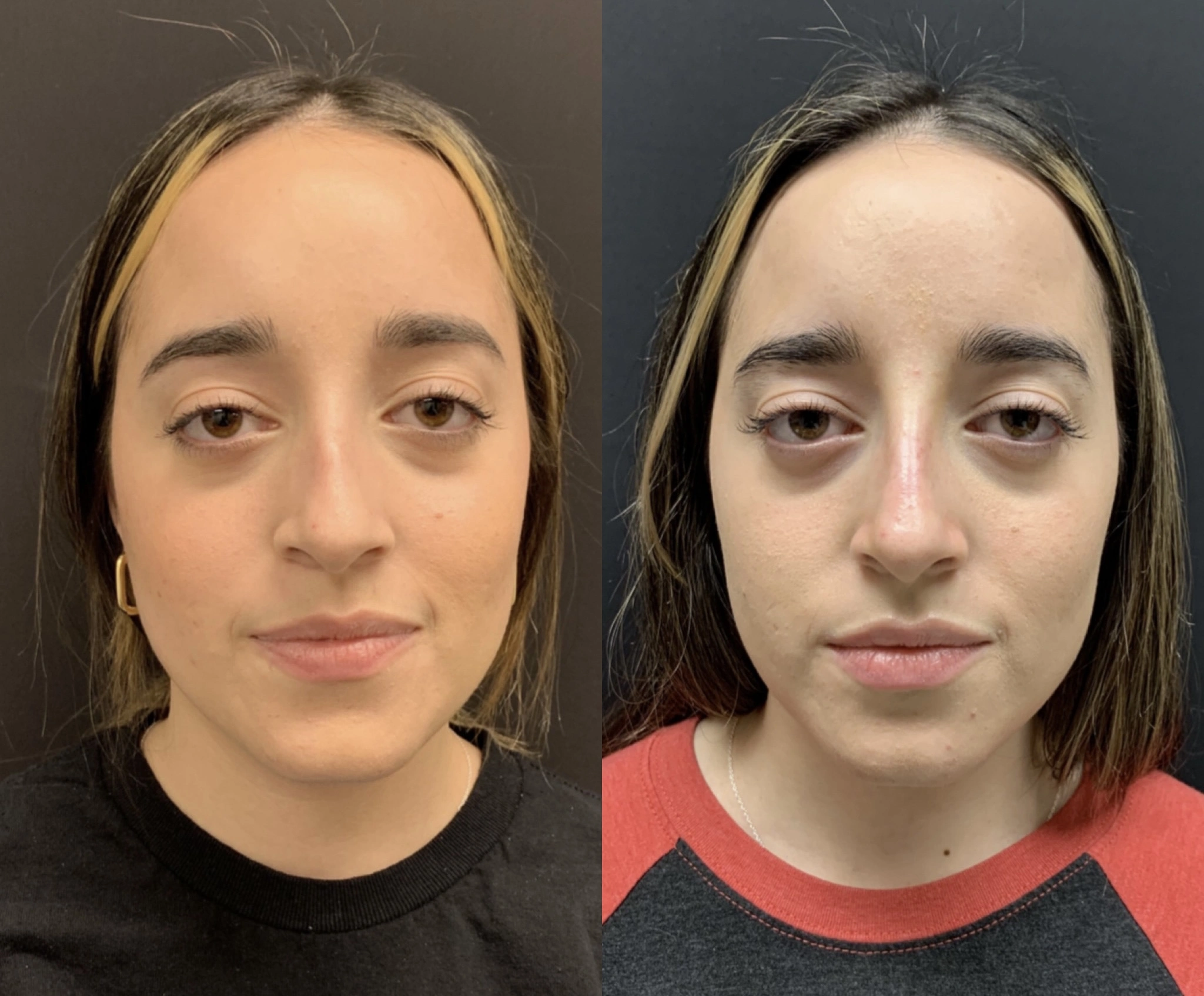 NON-SURGICAL RHINOPLASTY Before & After Case Number 0009