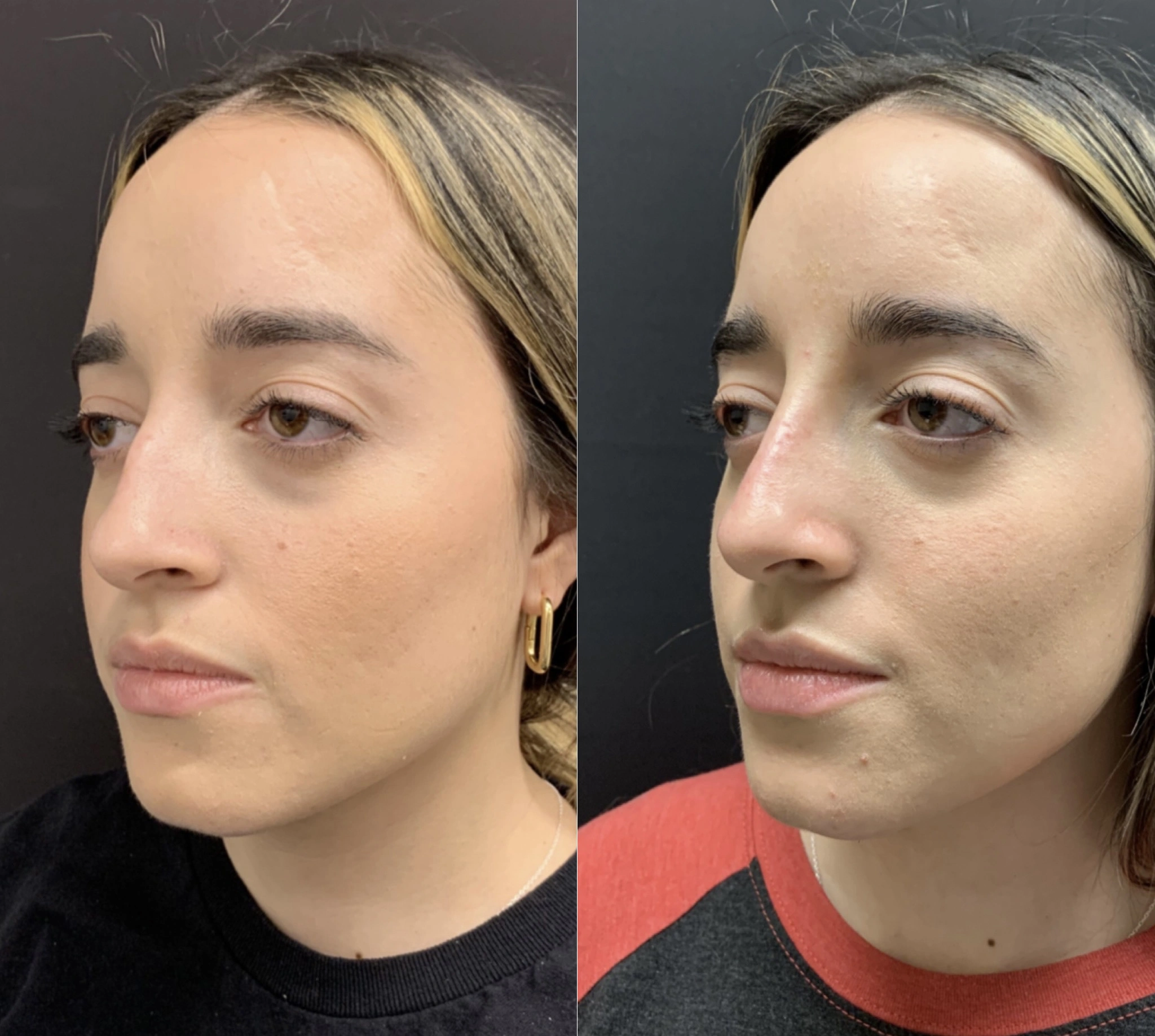 NON-SURGICAL RHINOPLASTY Before & After Case Number 0009