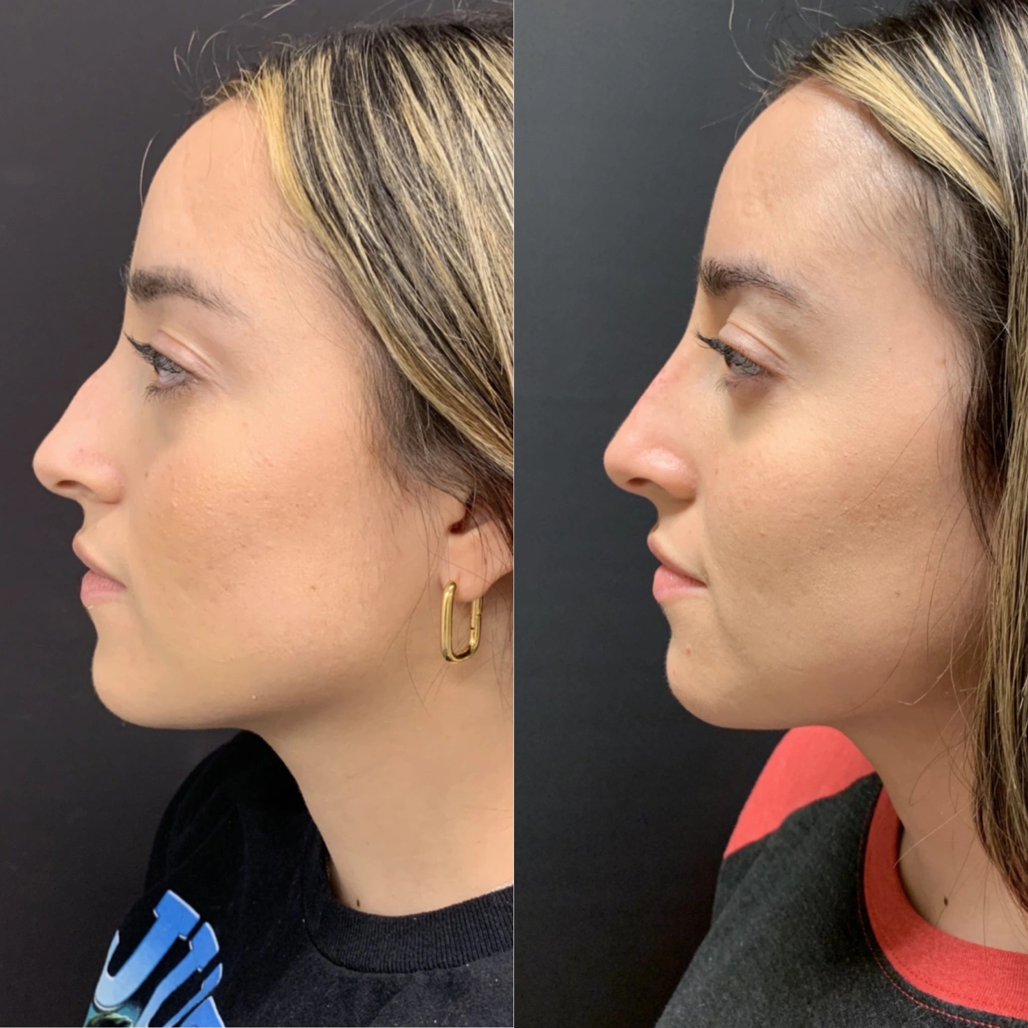 NON-SURGICAL RHINOPLASTY Before & After Case Number 0009
