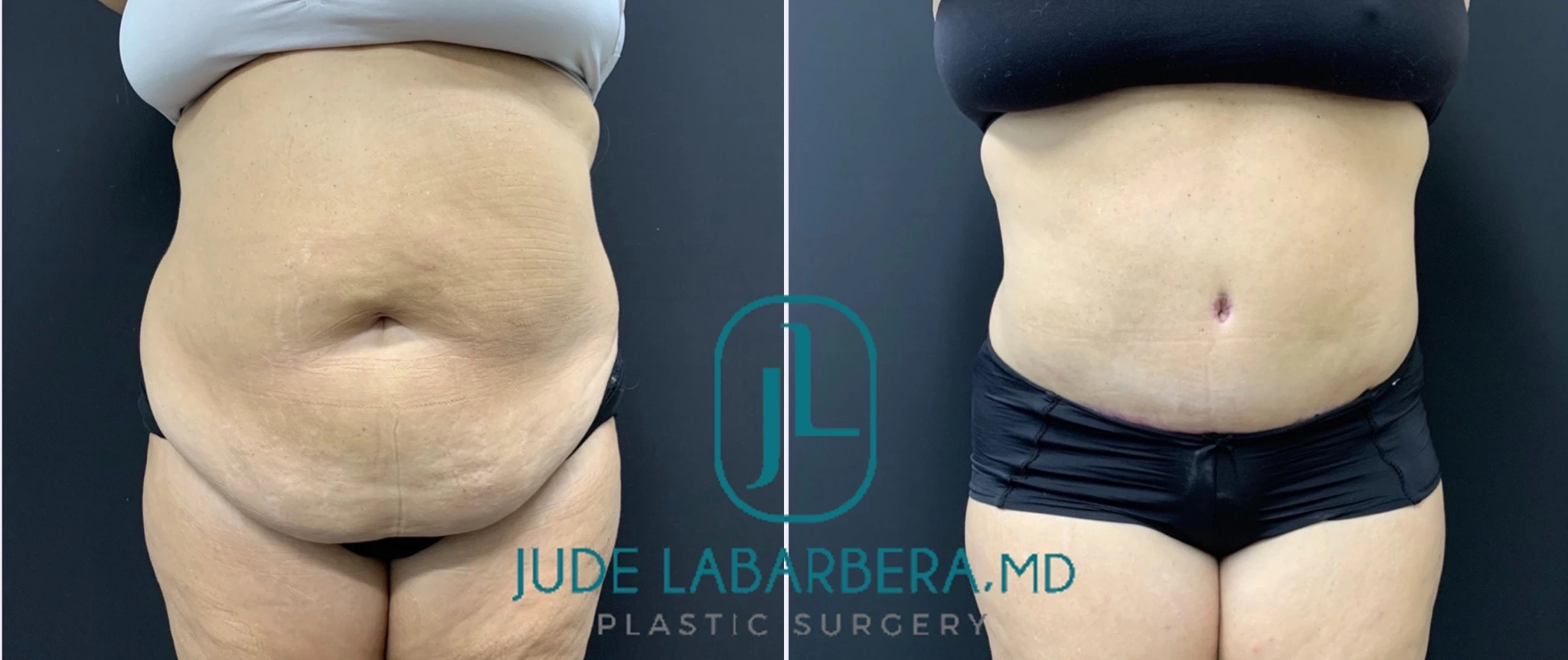 PLUS SIZE ABDOMINOPLASTY Before & After Case Number 000103