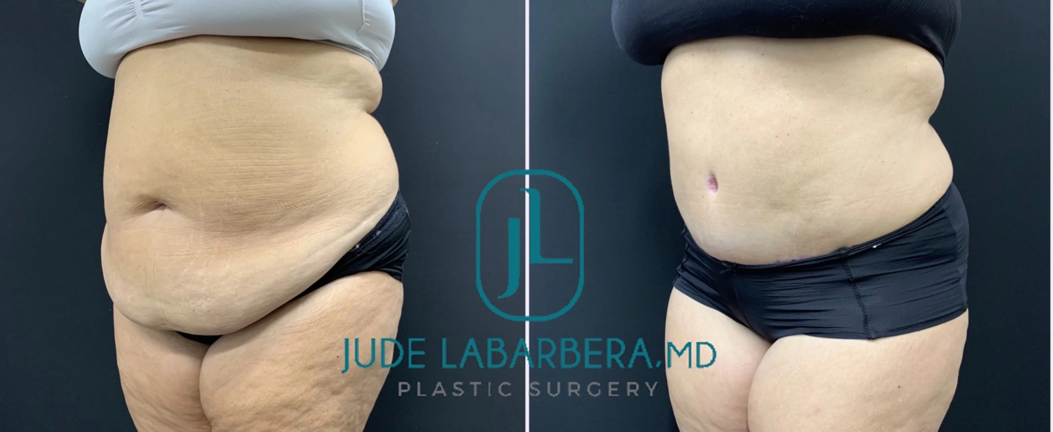 PLUS SIZE ABDOMINOPLASTY Before & After Case Number 000103