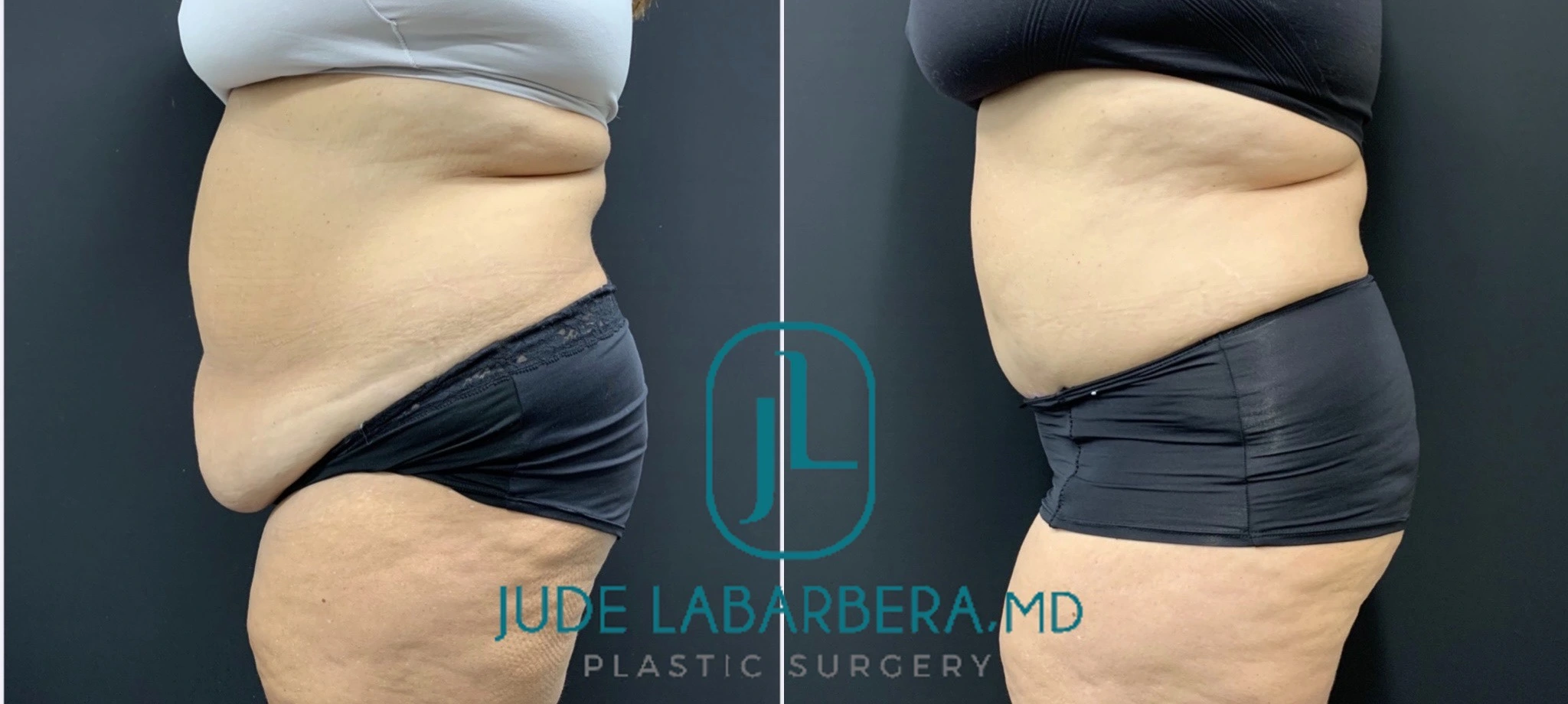 PLUS SIZE ABDOMINOPLASTY Before & After Case Number 000103