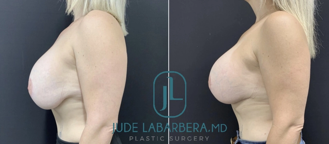 REVISION BREAST Procedure Before & After Case Number 0002