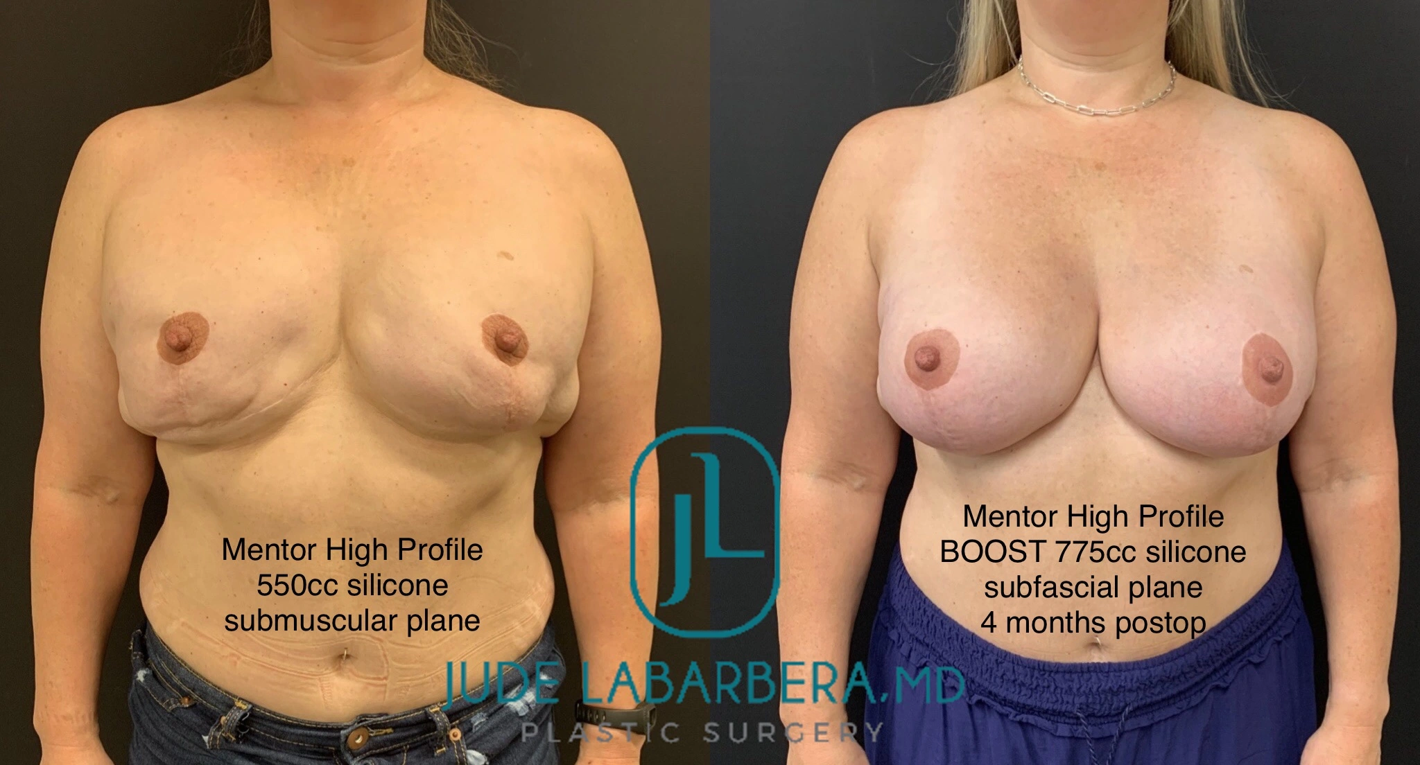 REVISION BREAST SURGERY Before & After Case Number 00010