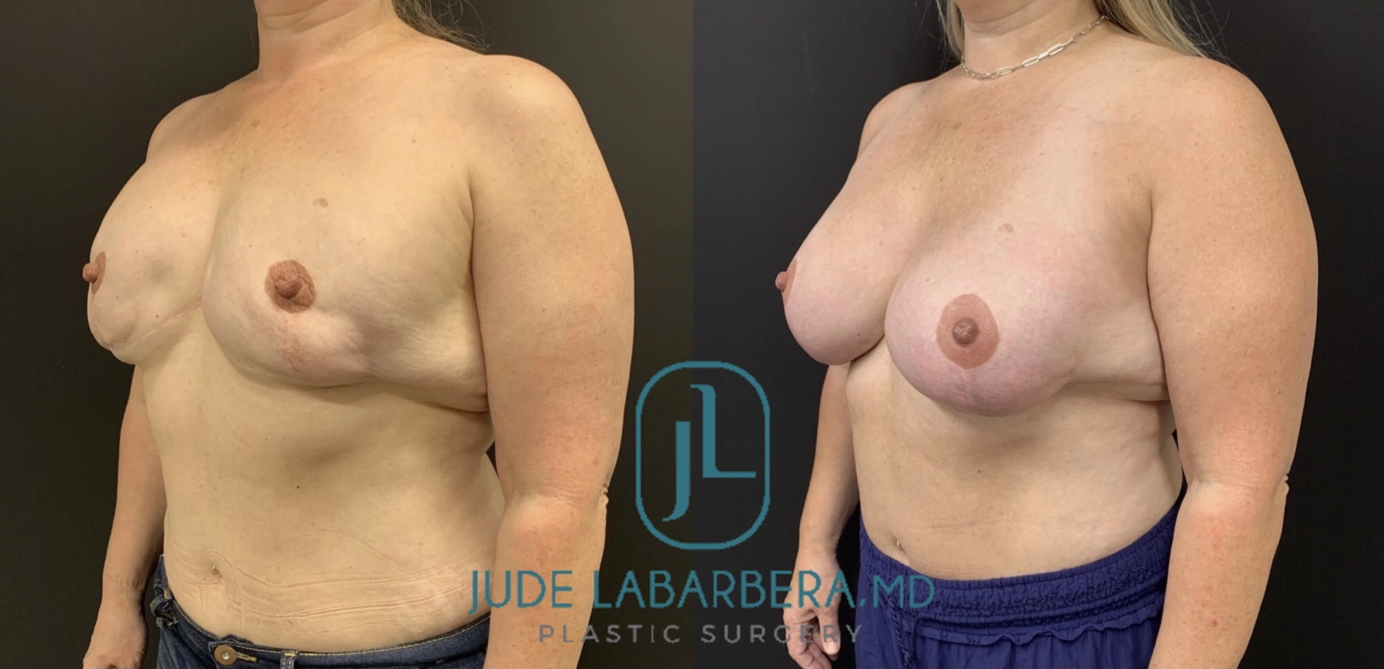 REVISION BREAST SURGERY Before & After Case Number 00010