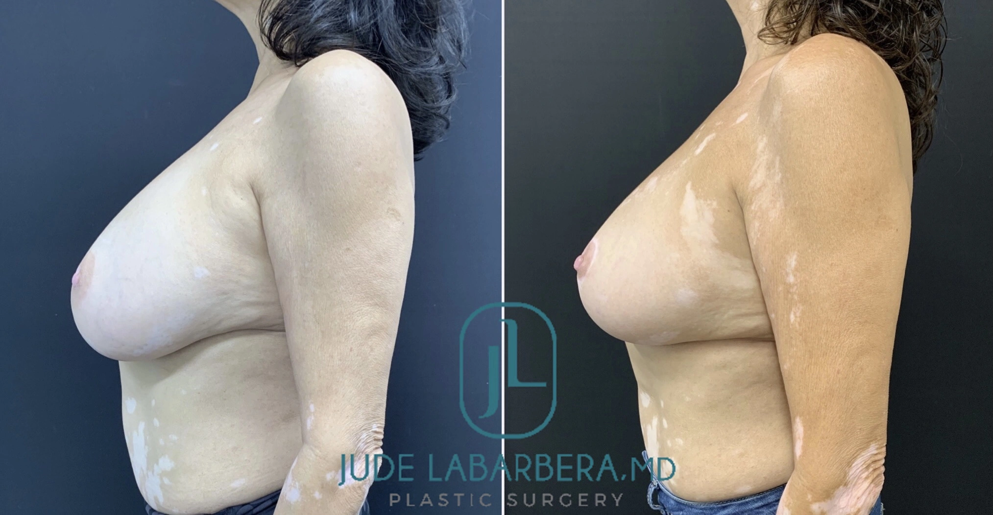 REVISION BREAST SURGERY Before & After Case Number 0003