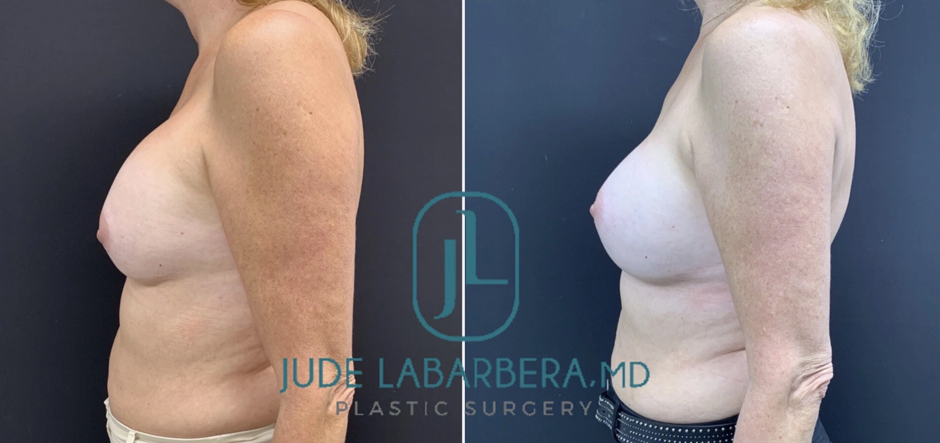 REVISION BREAST SURGERY Before & After Case Number 0005