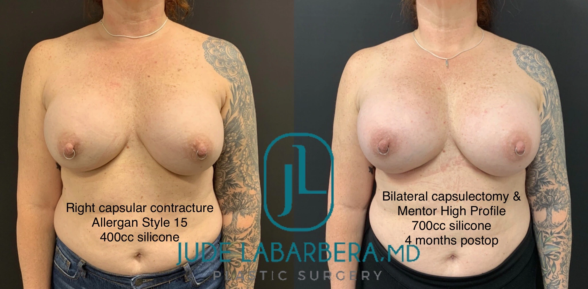 REVISION BREAST SURGERY Before & After Case Number 0007