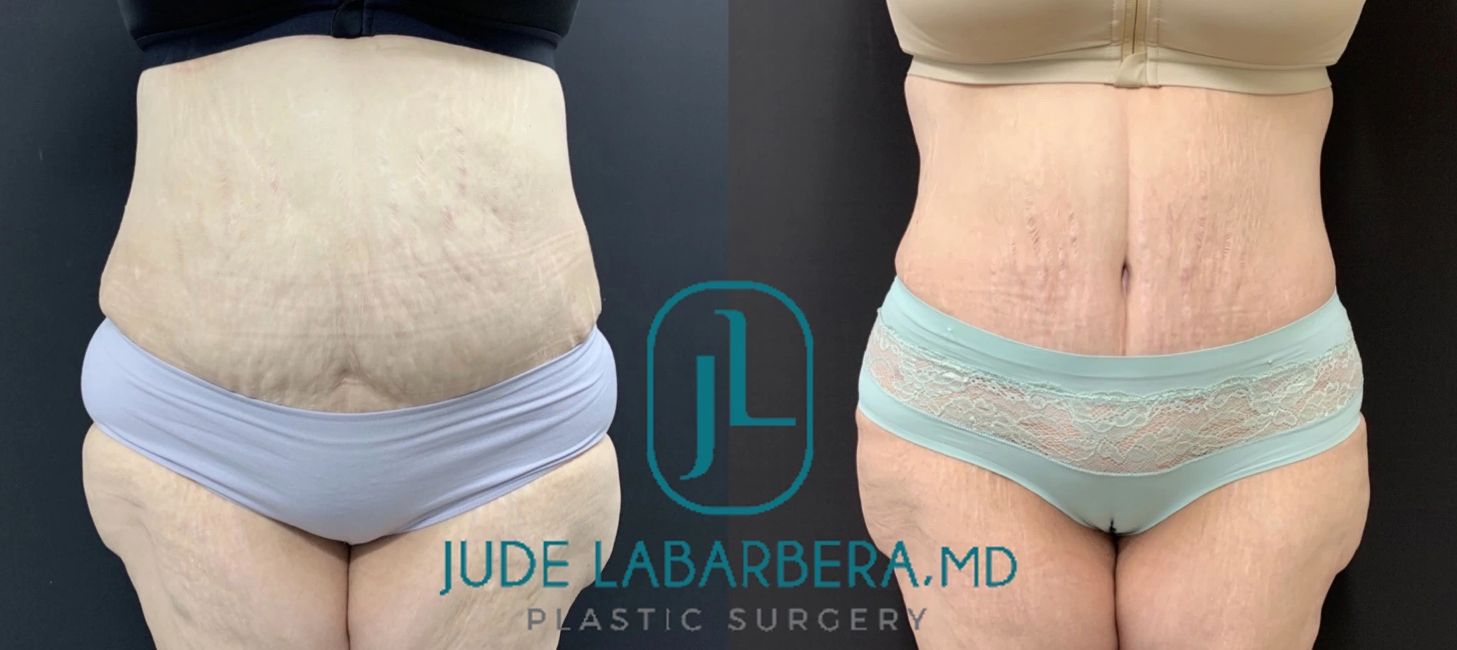 REVISION TUMMY TUCK WITH NEOUMBILICOPLASTY Before & After Case Number 00086